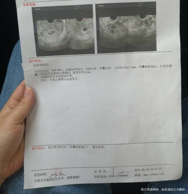 医生你好帮我看看b超单b超单上说孕囊偏小严重