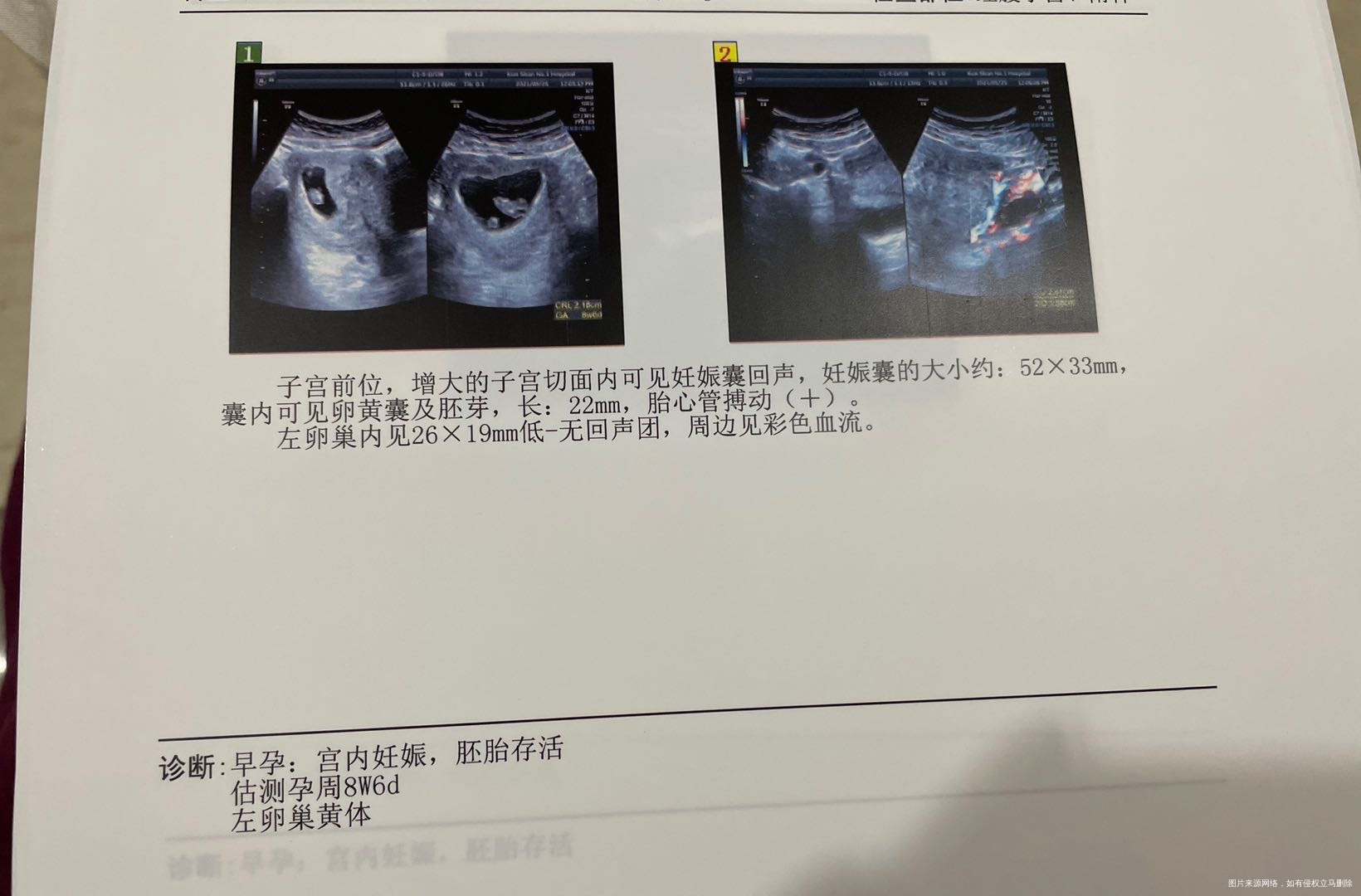 医生您好末次月经3/215/25日腹部b超显