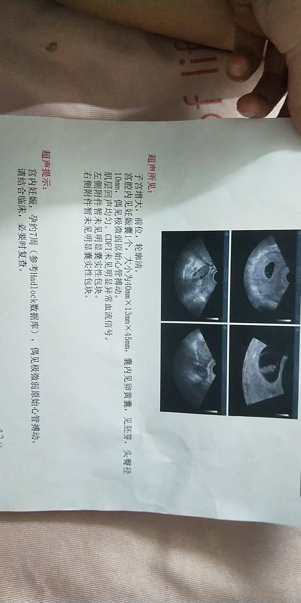 今天做b超胎心极微弱开了hcg黄体酮肝素打这