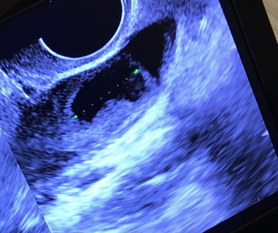 这个月没促排b超监测说是卵泡已排内膜101毫