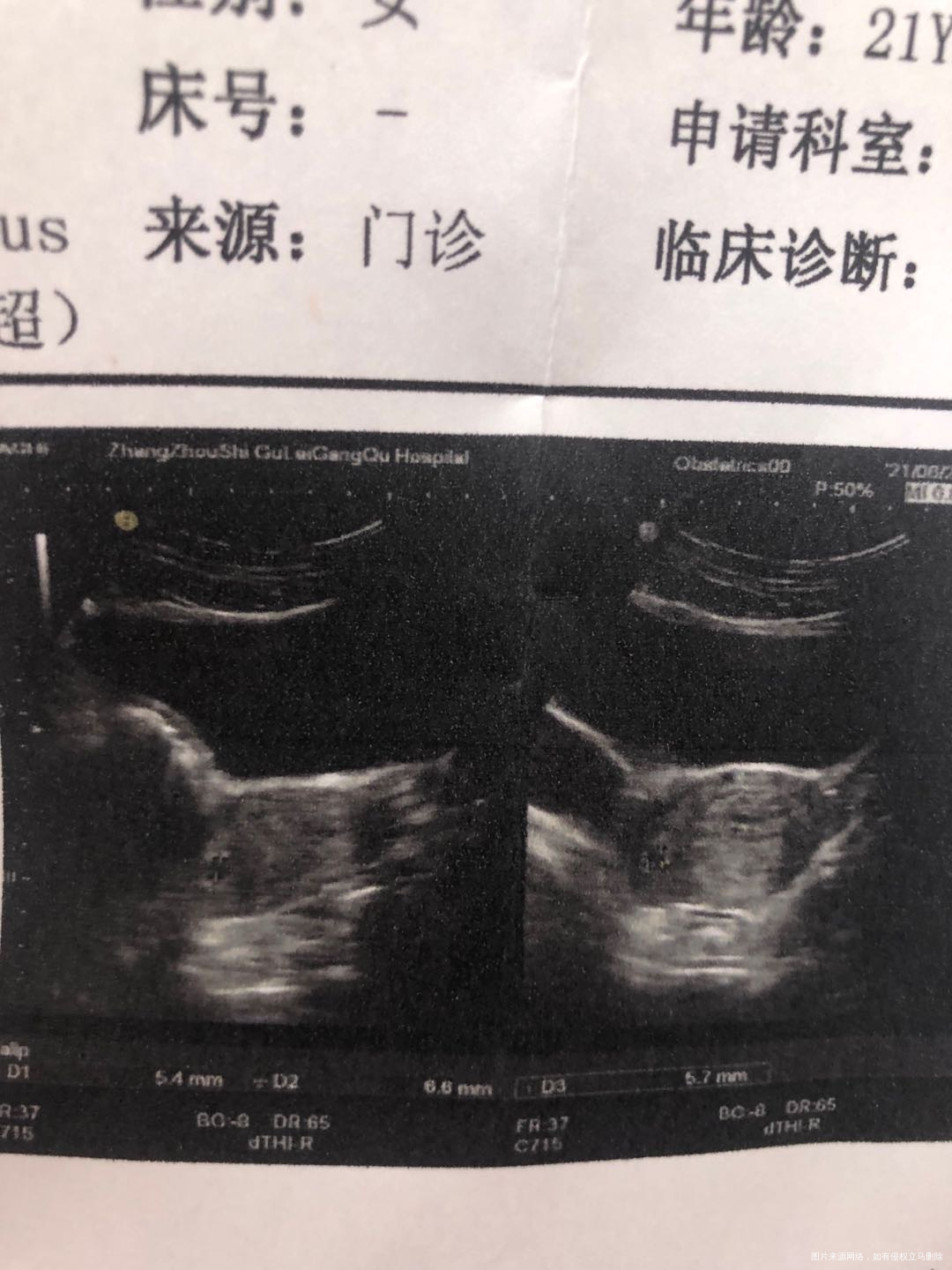 末次月经5月14日第39天的时候做个b超提示