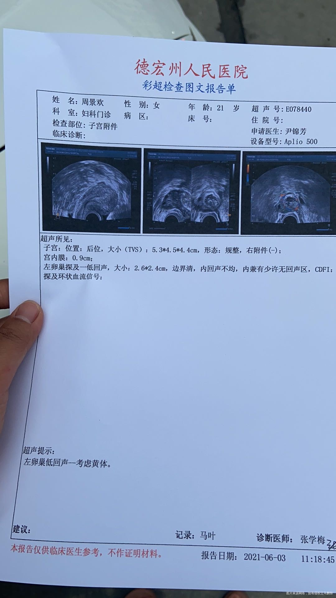 多囊4月28的月经5月15做b超内膜7mm1