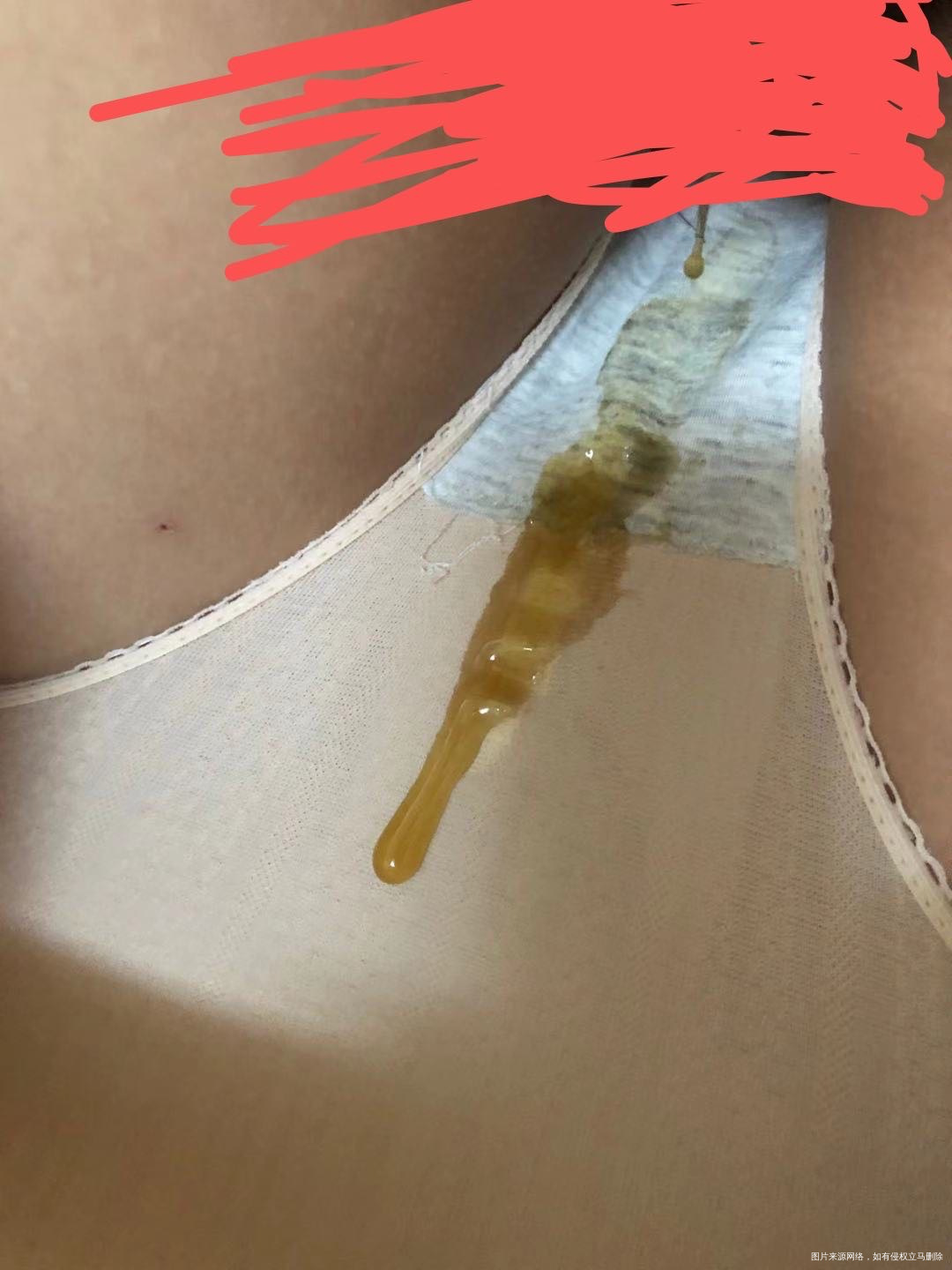 您好医生我现在怀孕12周三个月了昨天做完NT