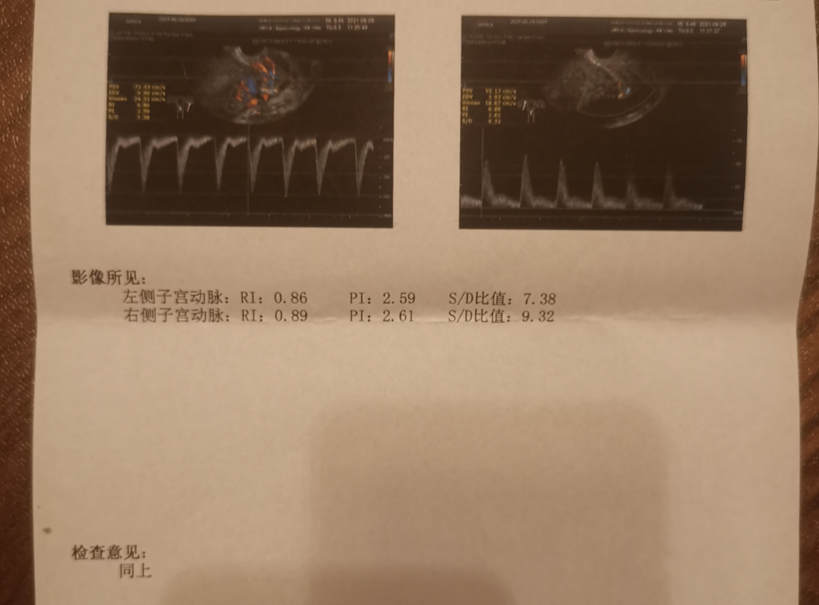 因AMH值077做的试管今天移植后第19天早