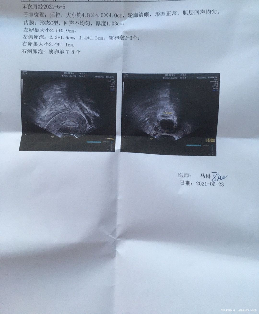 23号打的绒促和醋酸曲普瑞林26号去医院已排