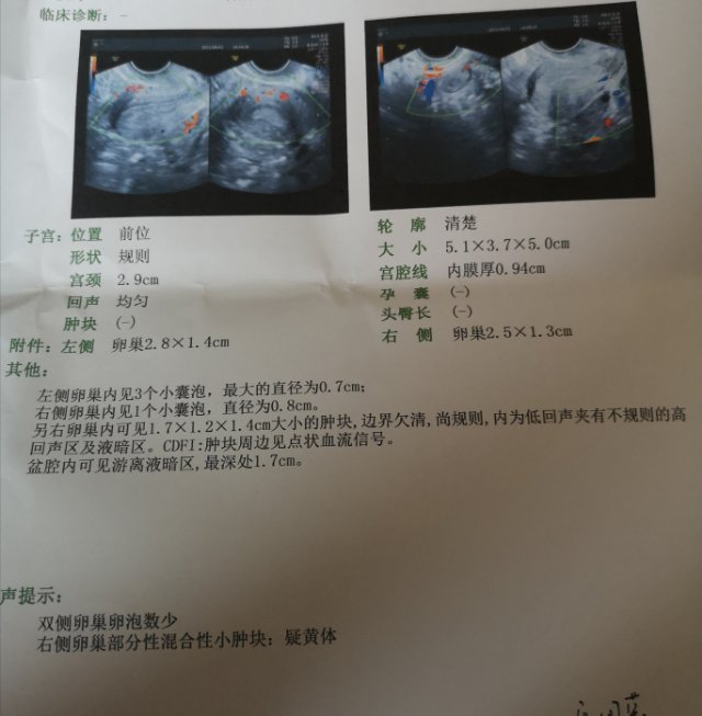 我这个报告上写有肿块暗流区边界不清有血块黄体