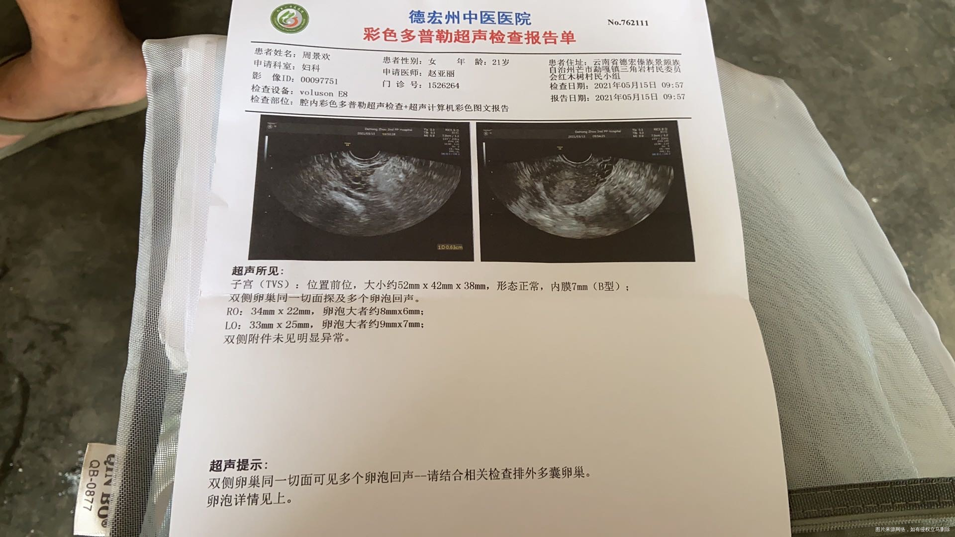 多囊4月28的月经5月15做b超内膜7mm1