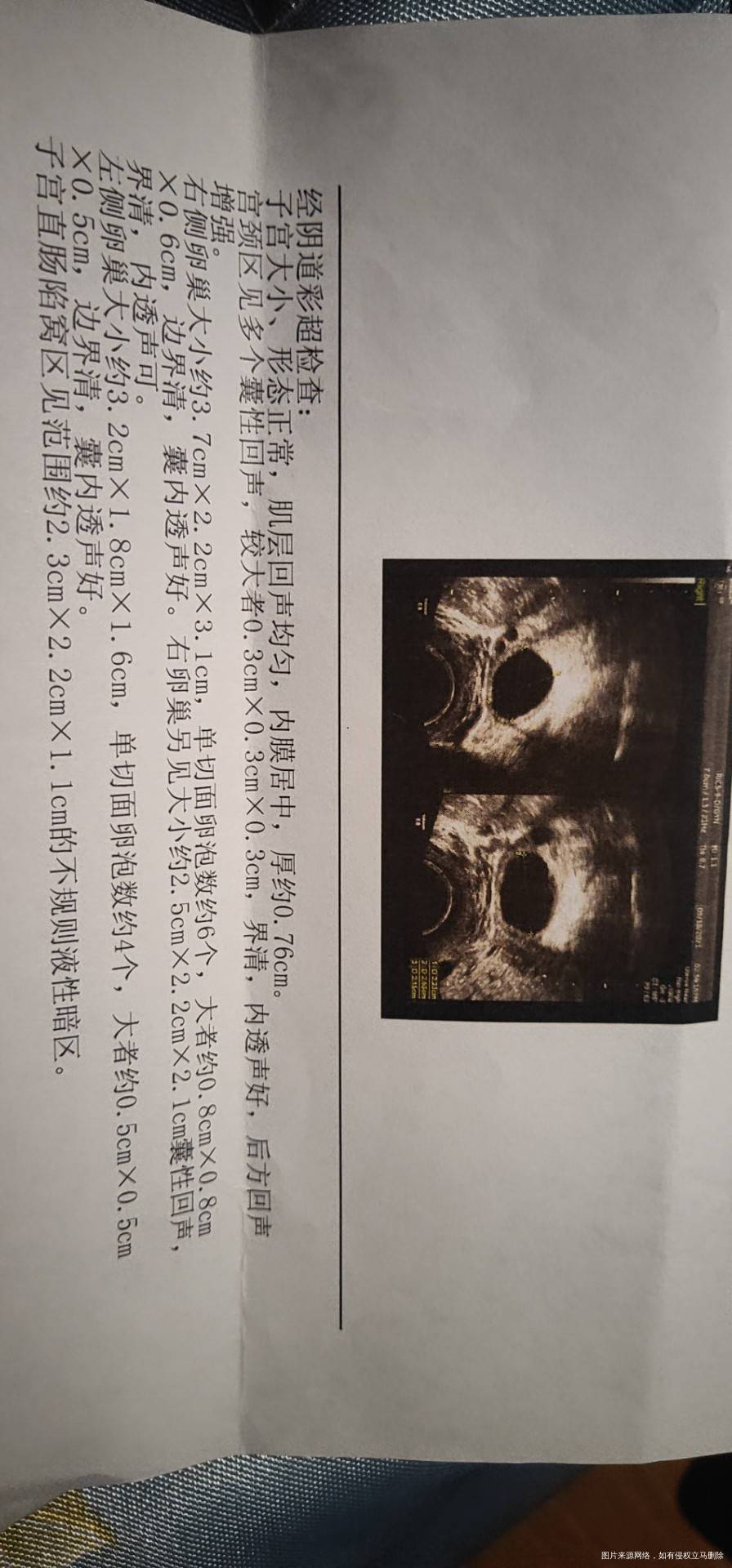 月经第十天去检测卵泡有优质卵泡大夫让同房月经