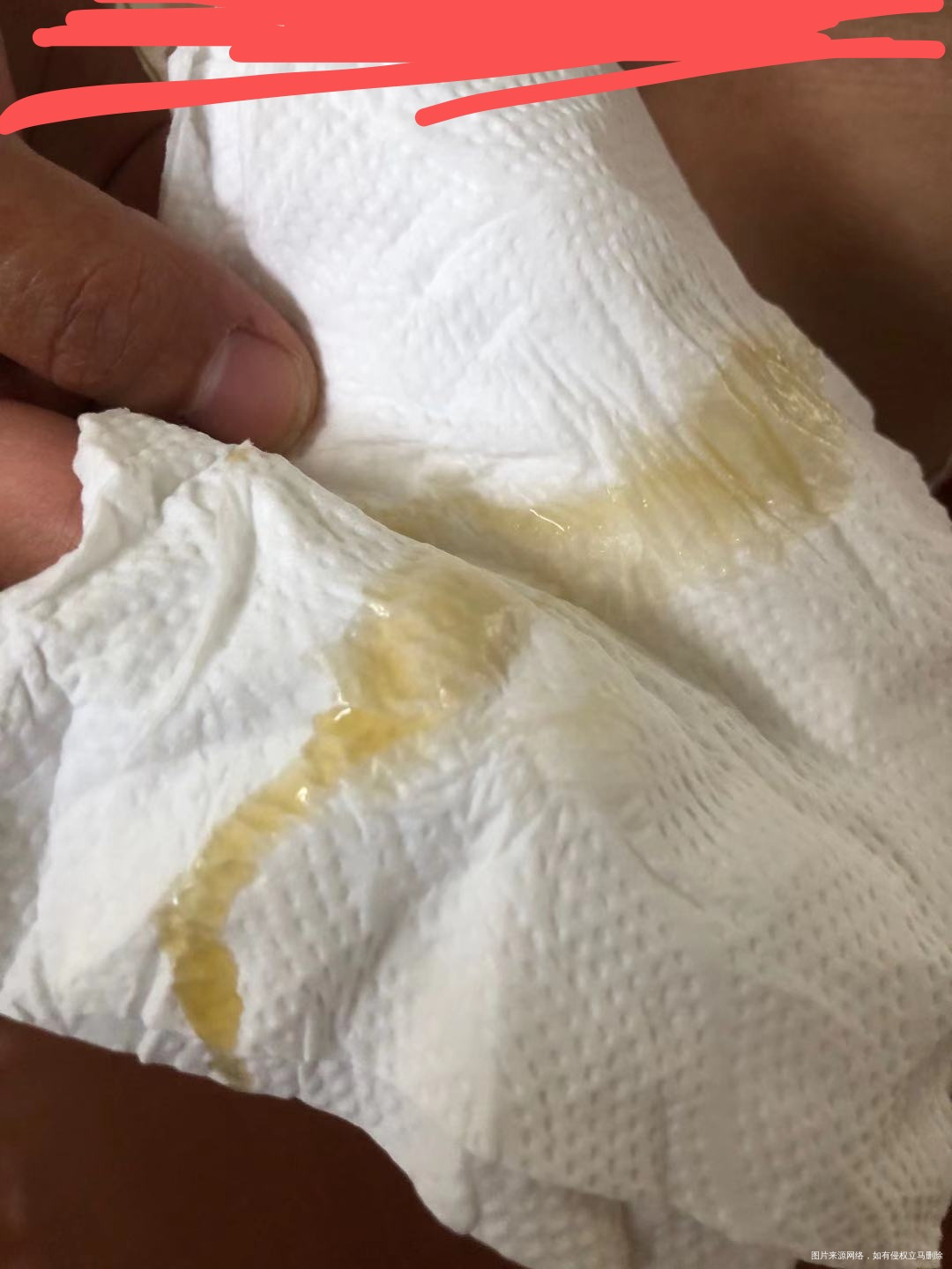 您好医生我现在怀孕12周三个月了昨天做完NT