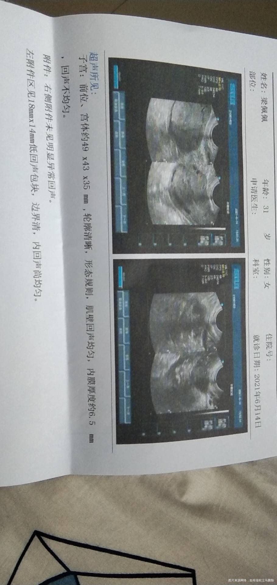试管移植怀孕57天没有胎心搏动宣告胎停建议药