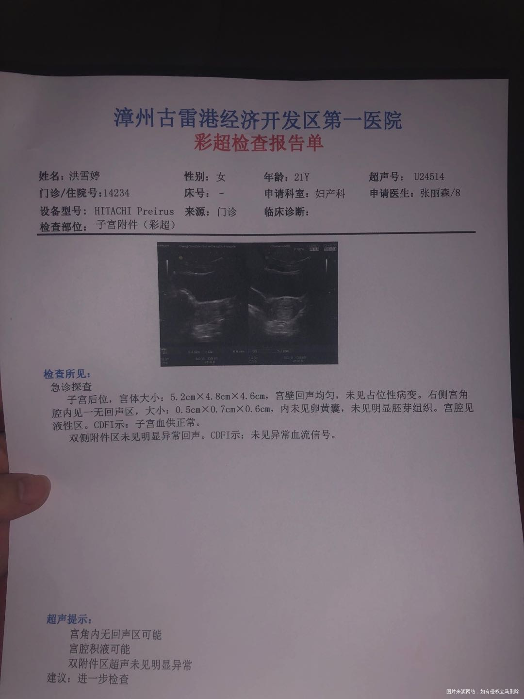 末次月经5月14日第39天的时候做个b超提示