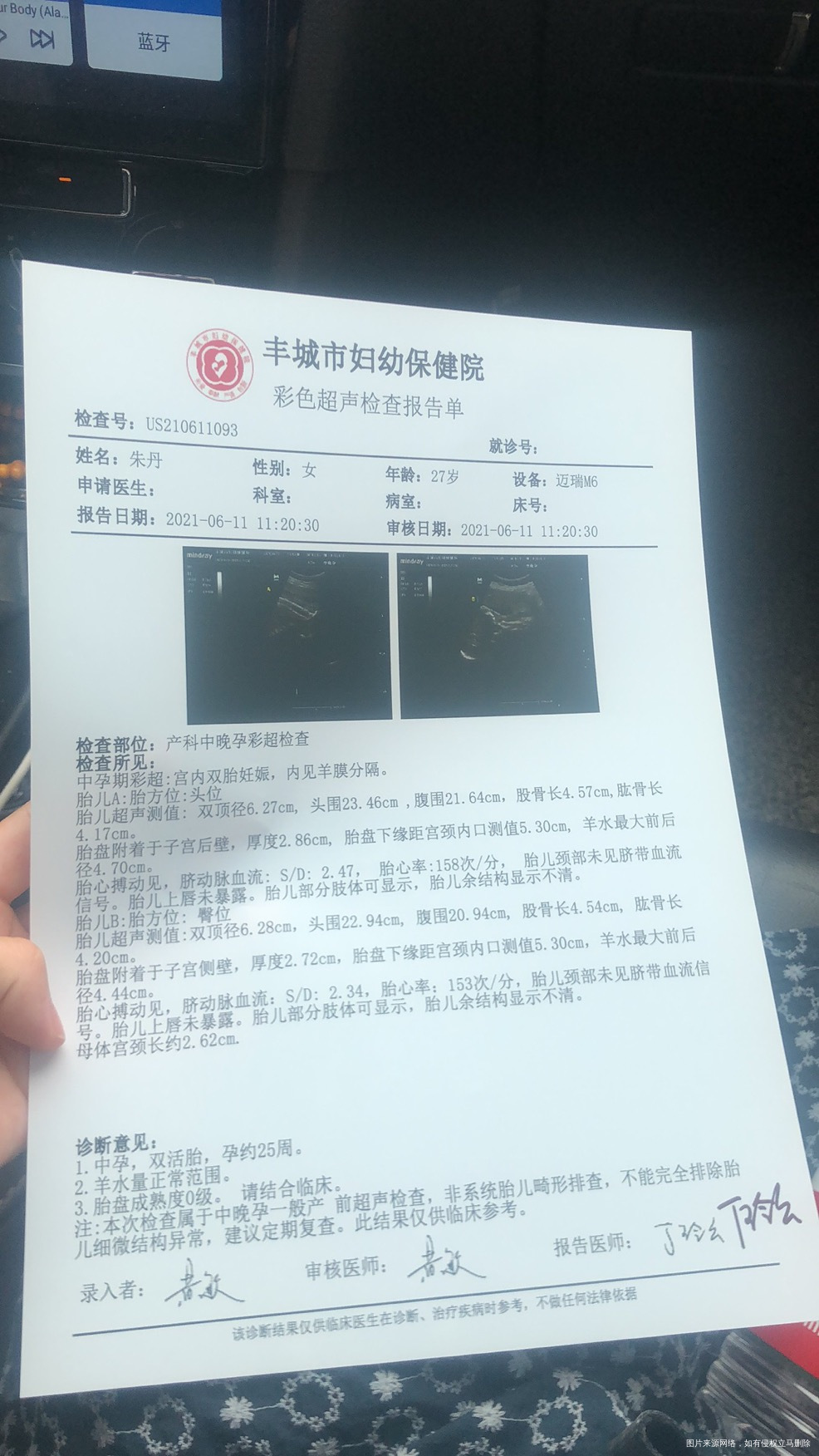 今天25➕5天试管双胎宫颈长度只有262cm