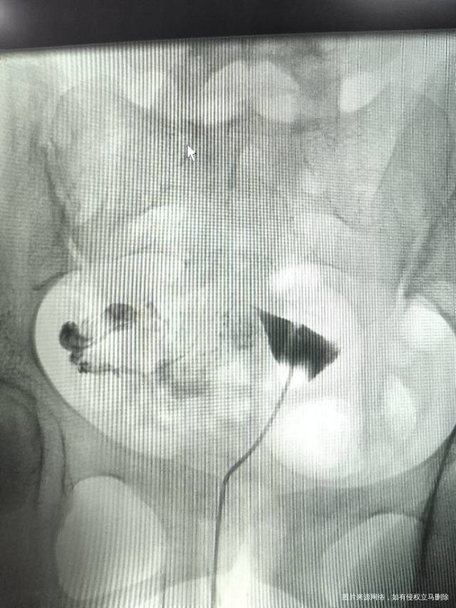 两侧输卵管堵试管成功率高吗