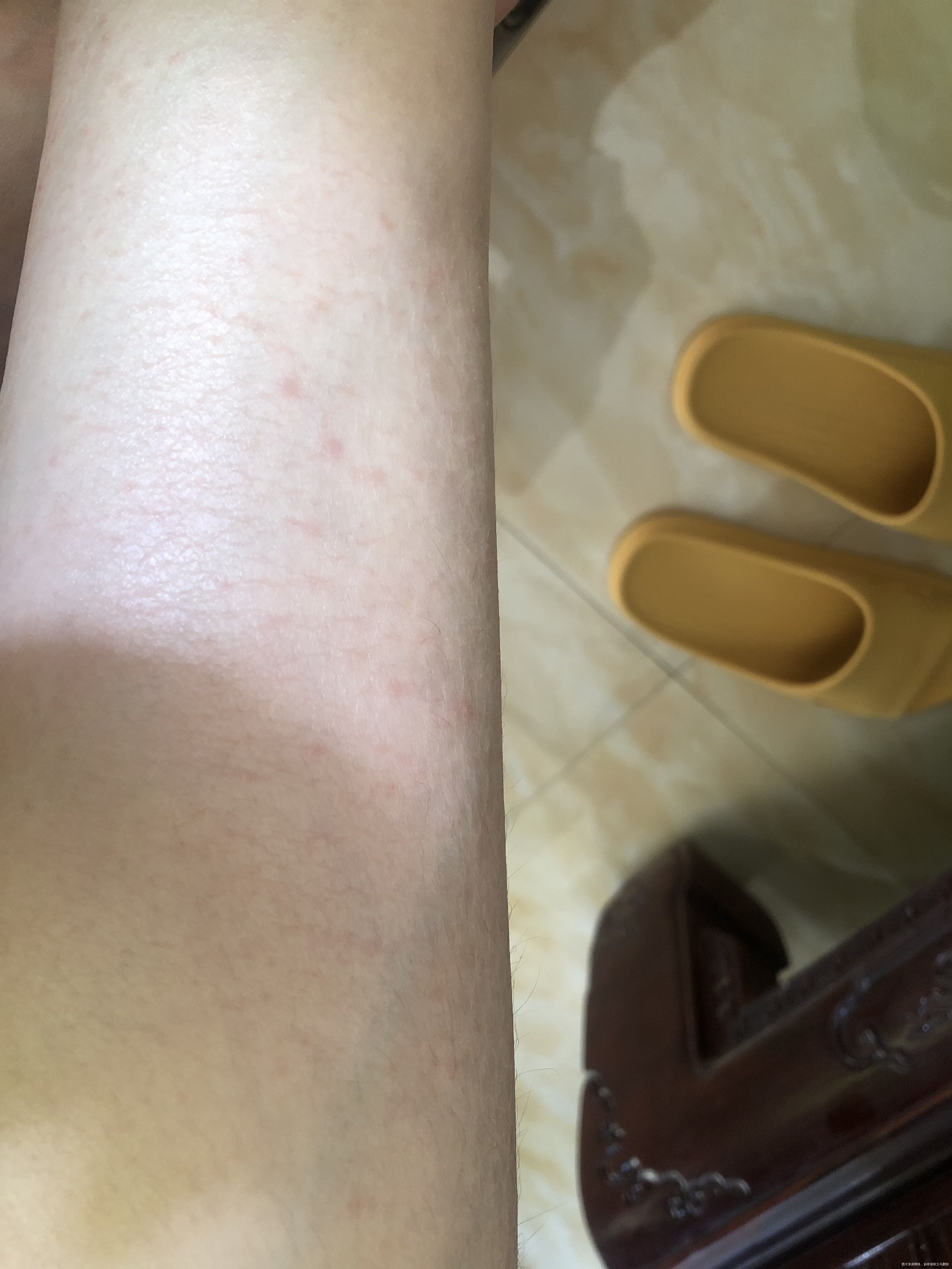 现在孕13周昨天开始脚踝以上就这样红疹子而且