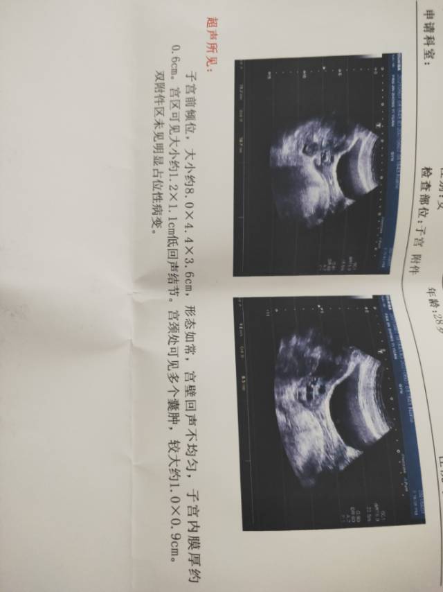 我现在月经淋漓不尽然后还有子宫肌瘤我该怎么办