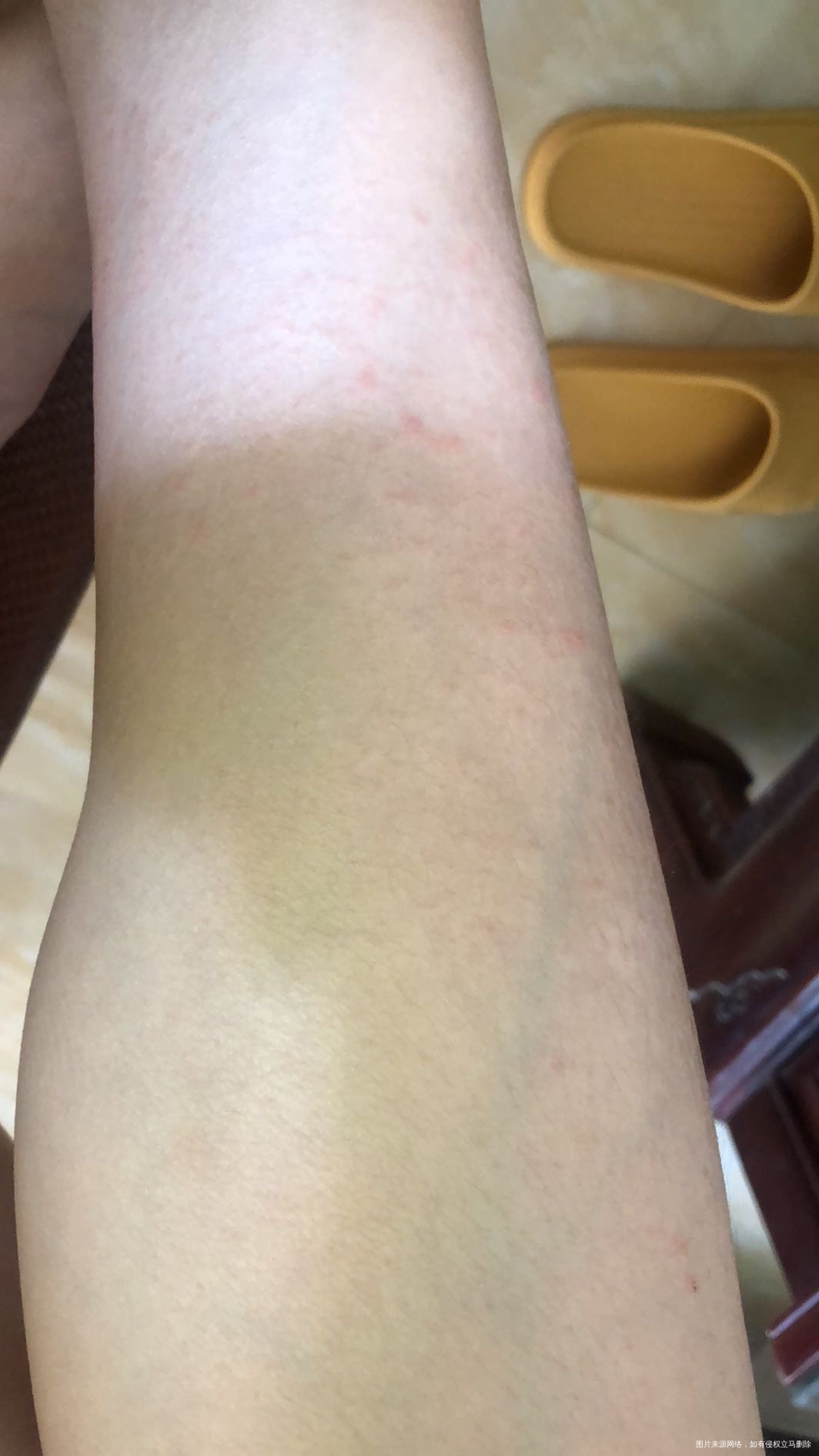 现在孕13周昨天开始脚踝以上就这样红疹子而且