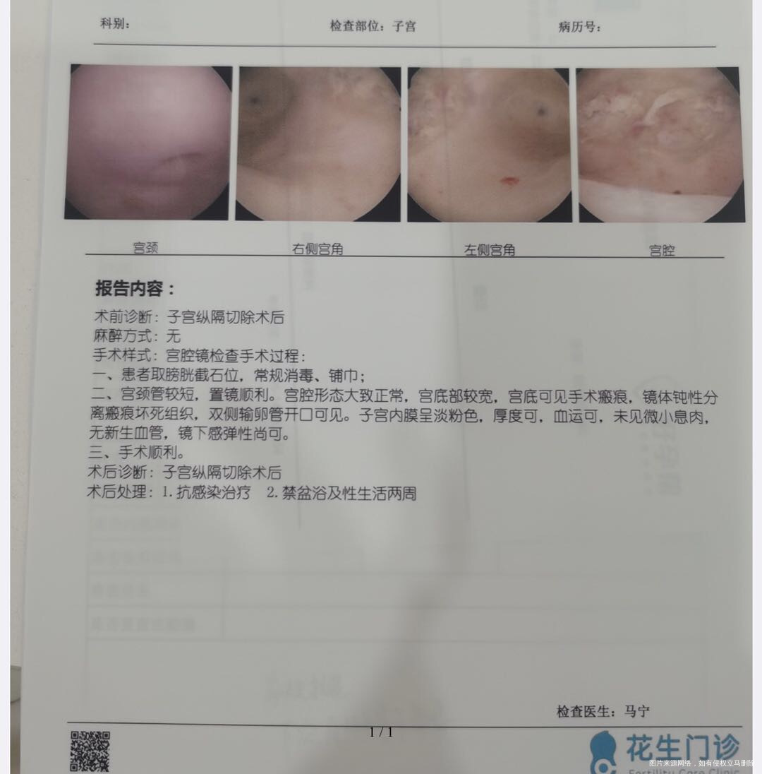 518由马宁医生进行了宫腹腔镜联合手术矫正双