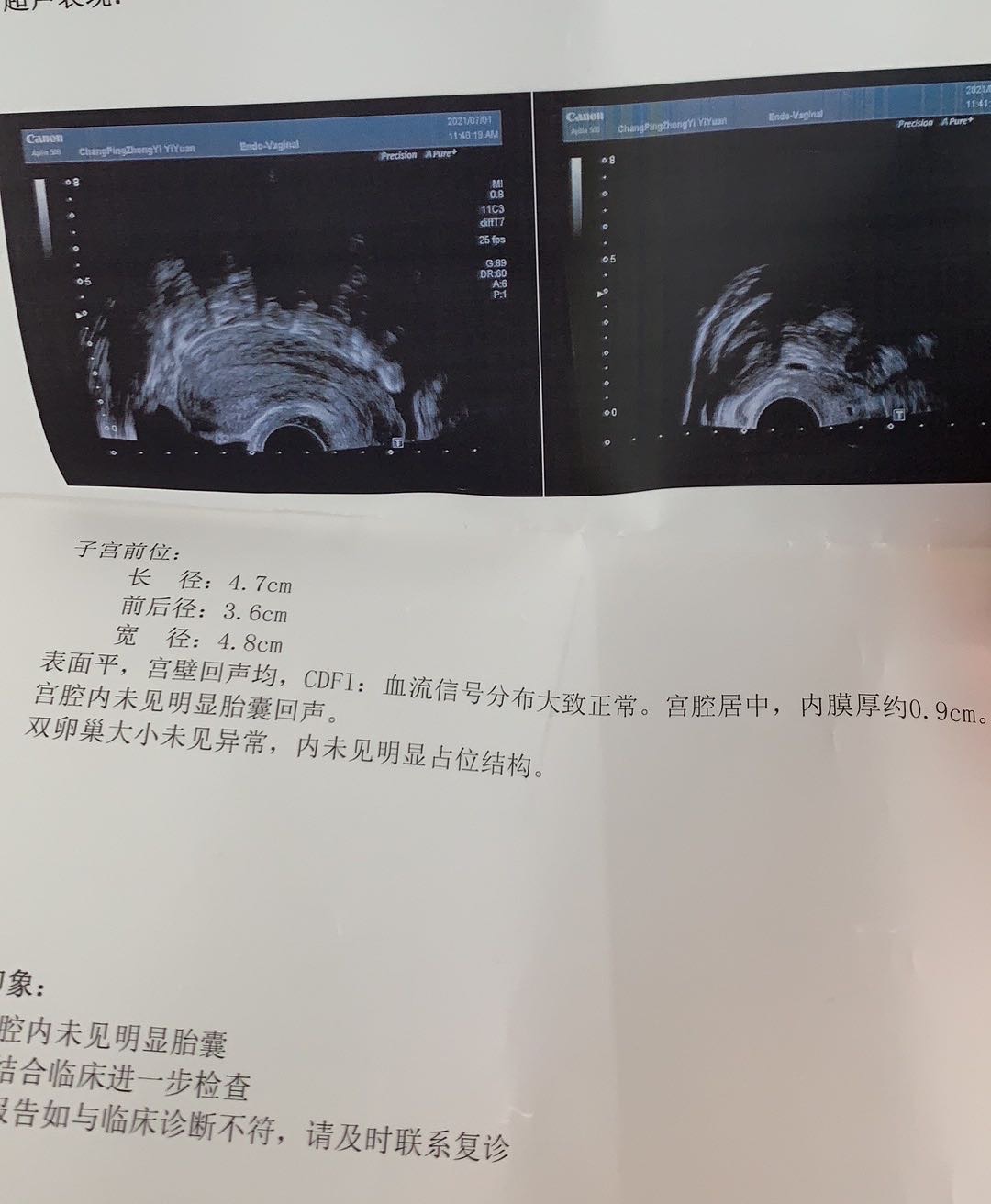 我想知道我是宫外孕吗我月经一直不准都是推迟一