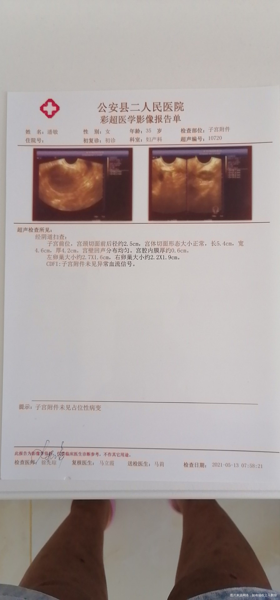 以前月经量多吃过抗精神病药物后月经量少了很多