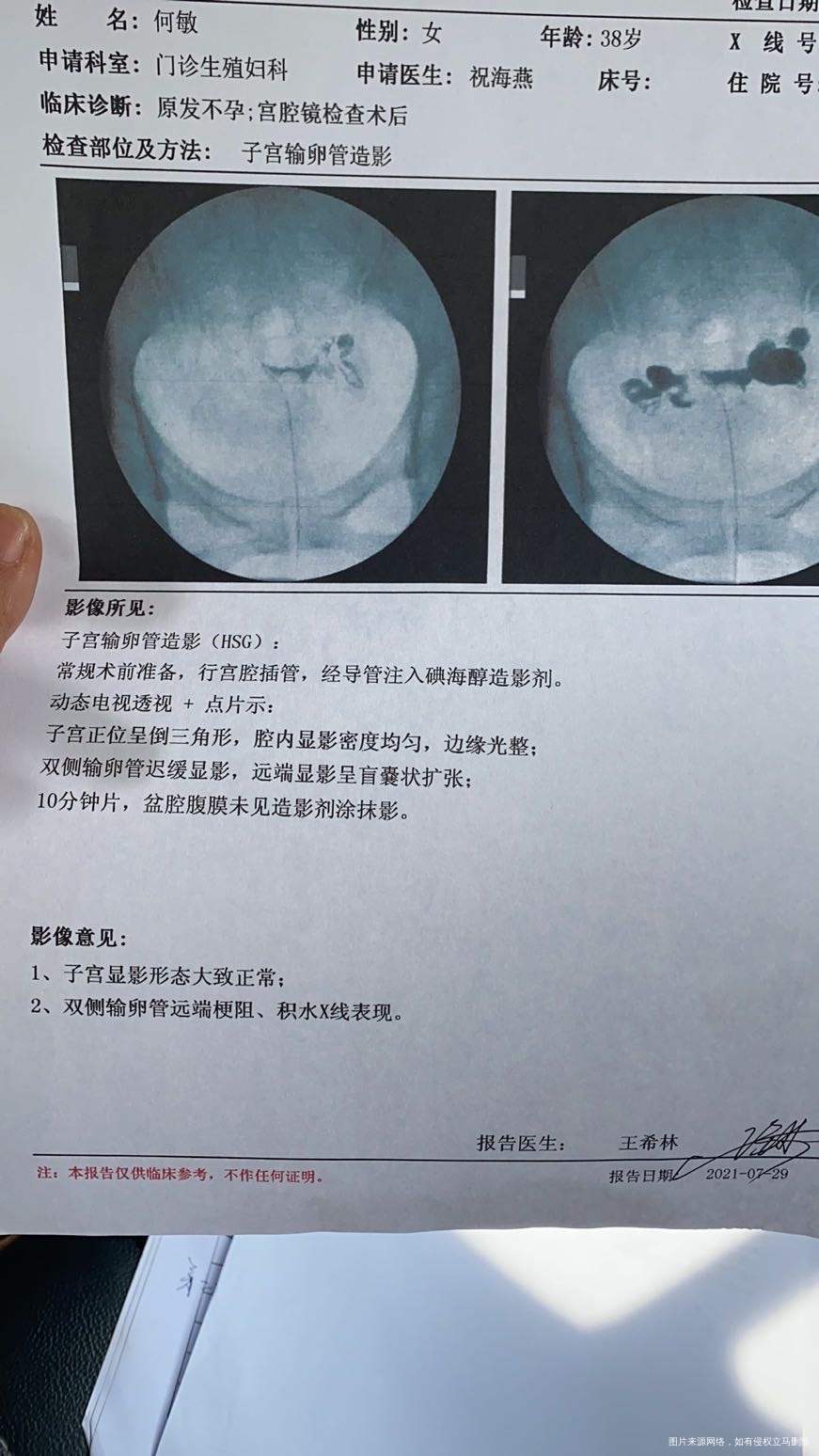 这边医生要求结扎是那种不能做吻合手术的结扎这
