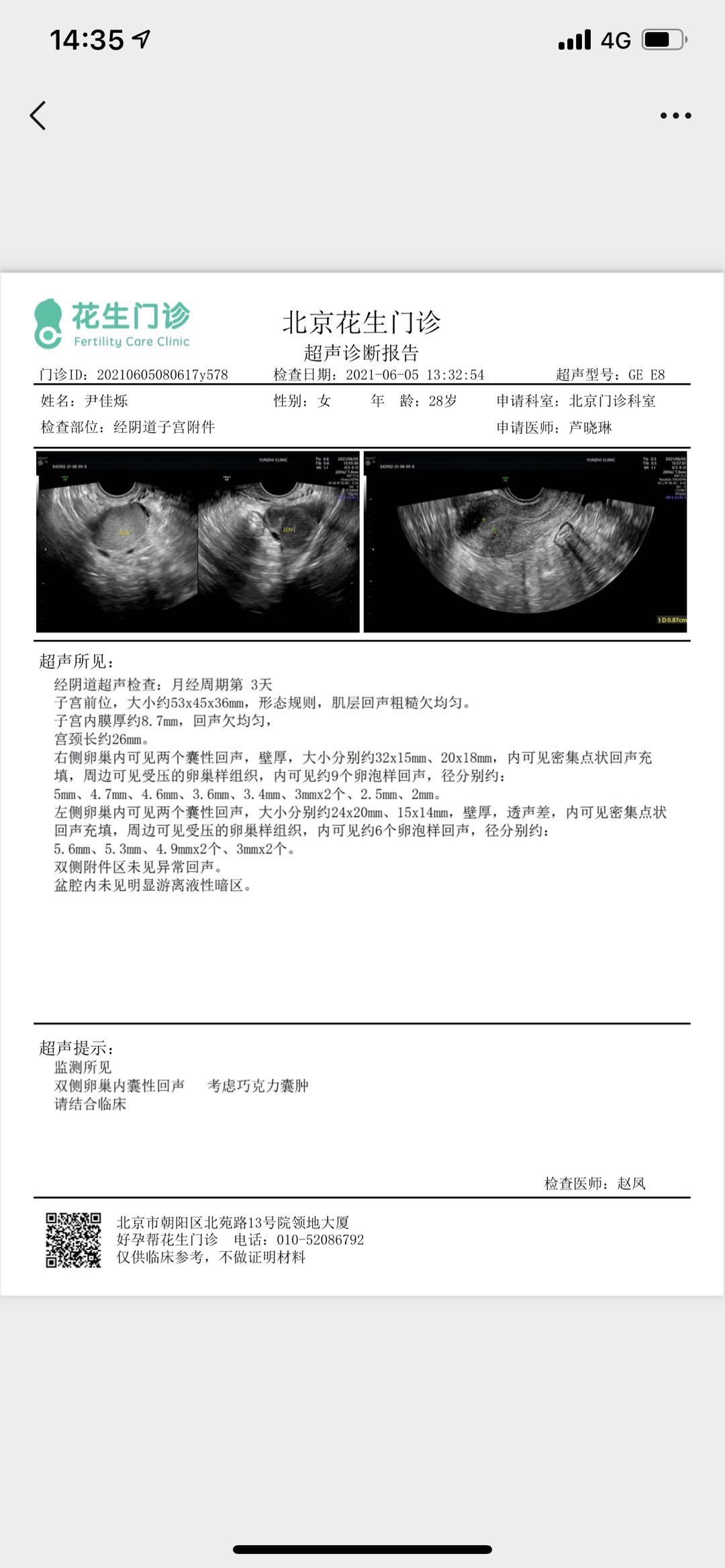 6月经期阴超监测双侧卵巢有囊肿左侧24✖️2