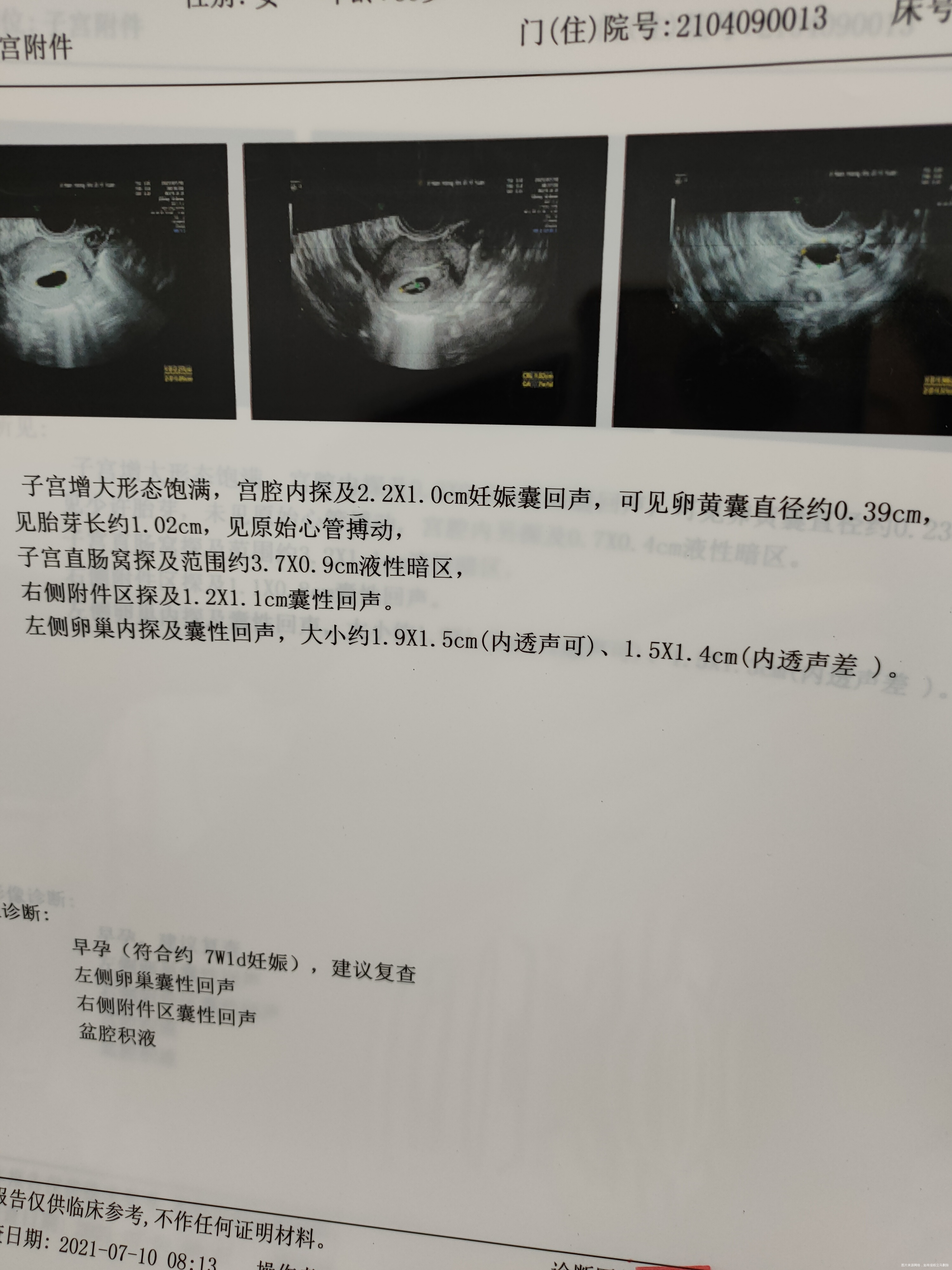 医生你好我想问一下我的盆腔积液35×09cm