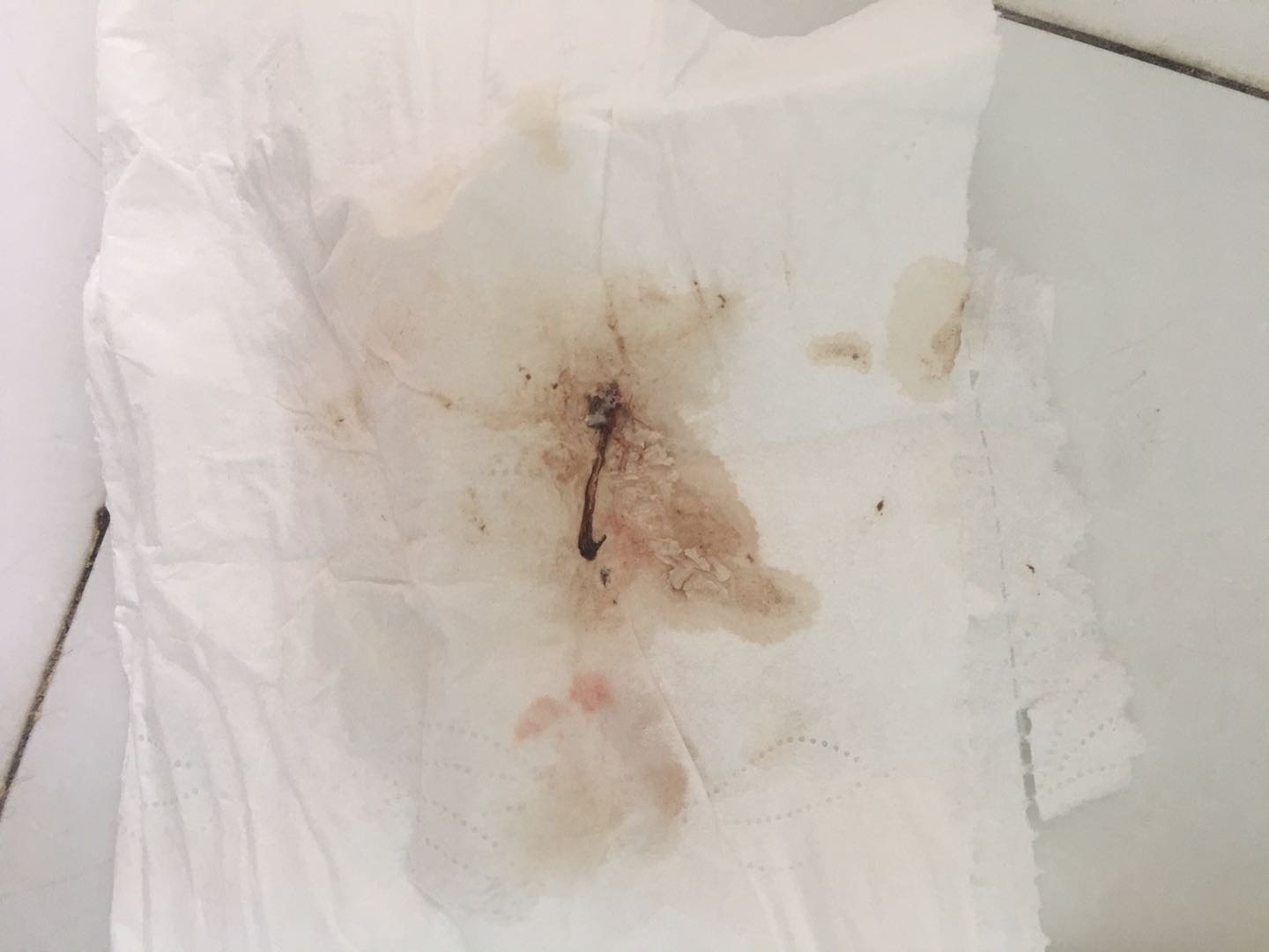 移植第七天左腹股沟以上到膝盖感觉酸酸的阴道伴