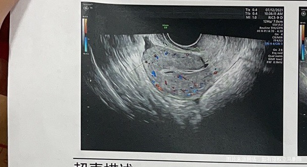 4月份胎停做了清宫手术后内膜一直很薄然后这个