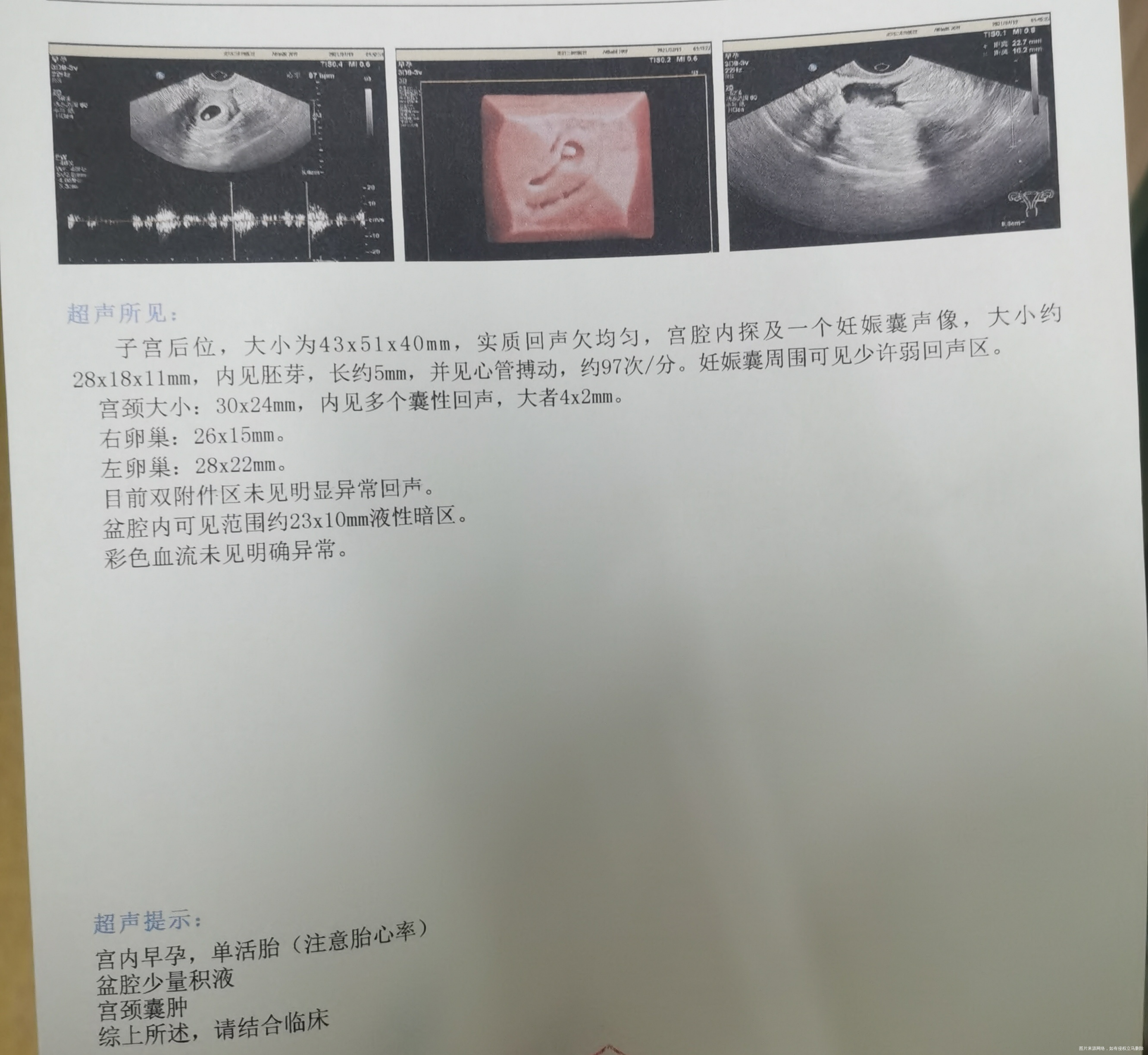 6月21日移植今天测胎心胎芽胎芽5mm胎心9