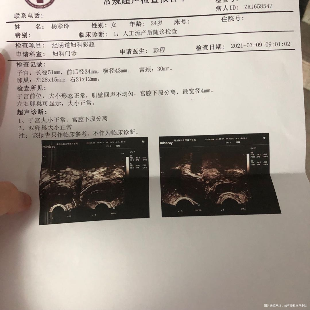 623胎停刮宫胚染异常9号跟21三倍体夫妻染