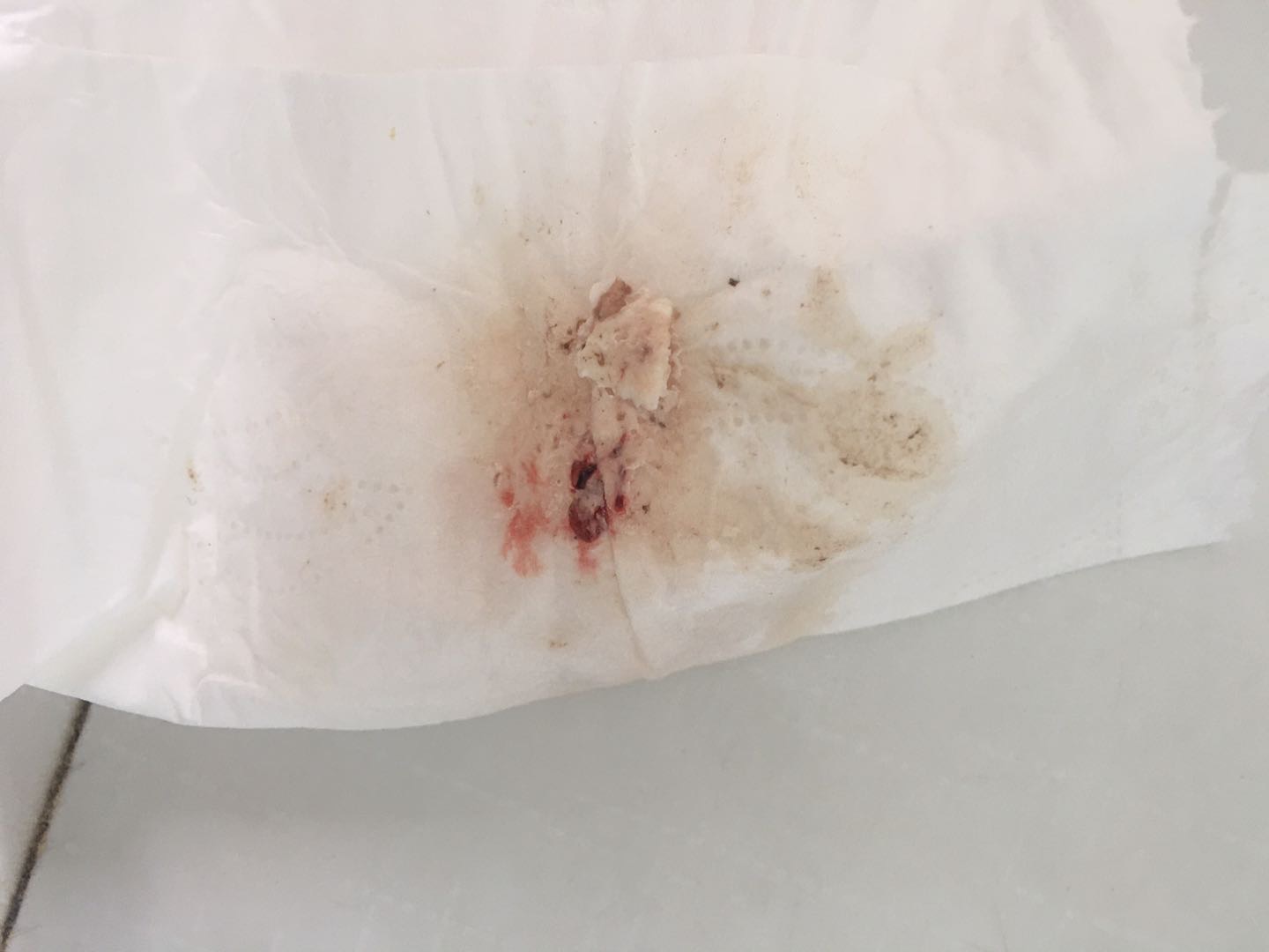 移植第七天左腹股沟以上到膝盖感觉酸酸的阴道伴