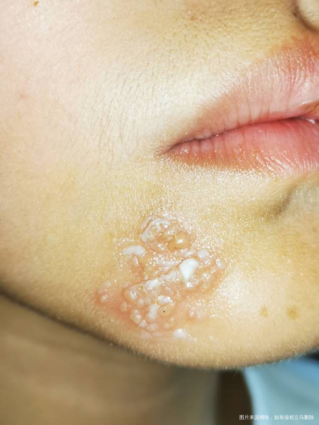 嘴角起来这些泡泡不知道是啥东西