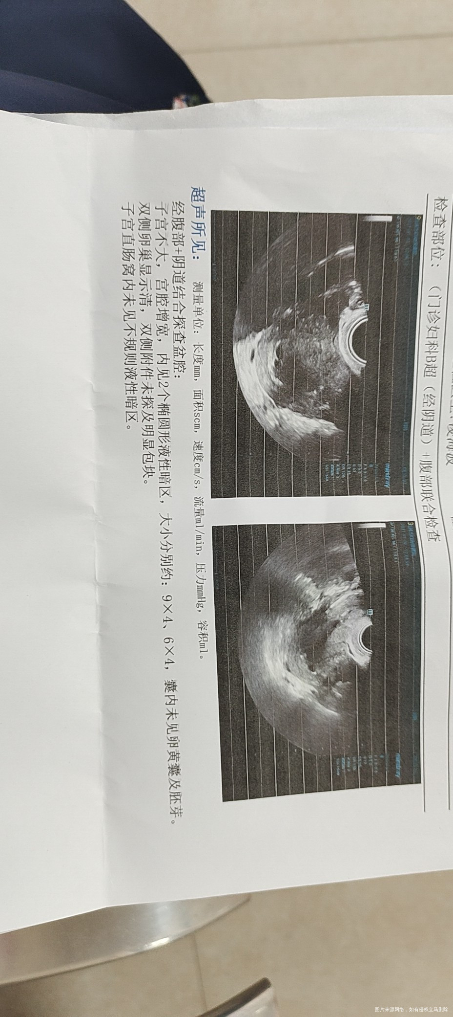 612移植两胚胎着床偏晚72照阴超结果如图请