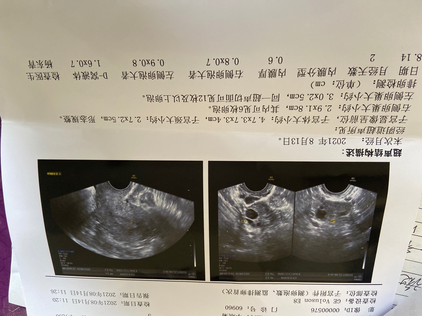 上个月吃了一个月达英35以前双侧多囊这个月左