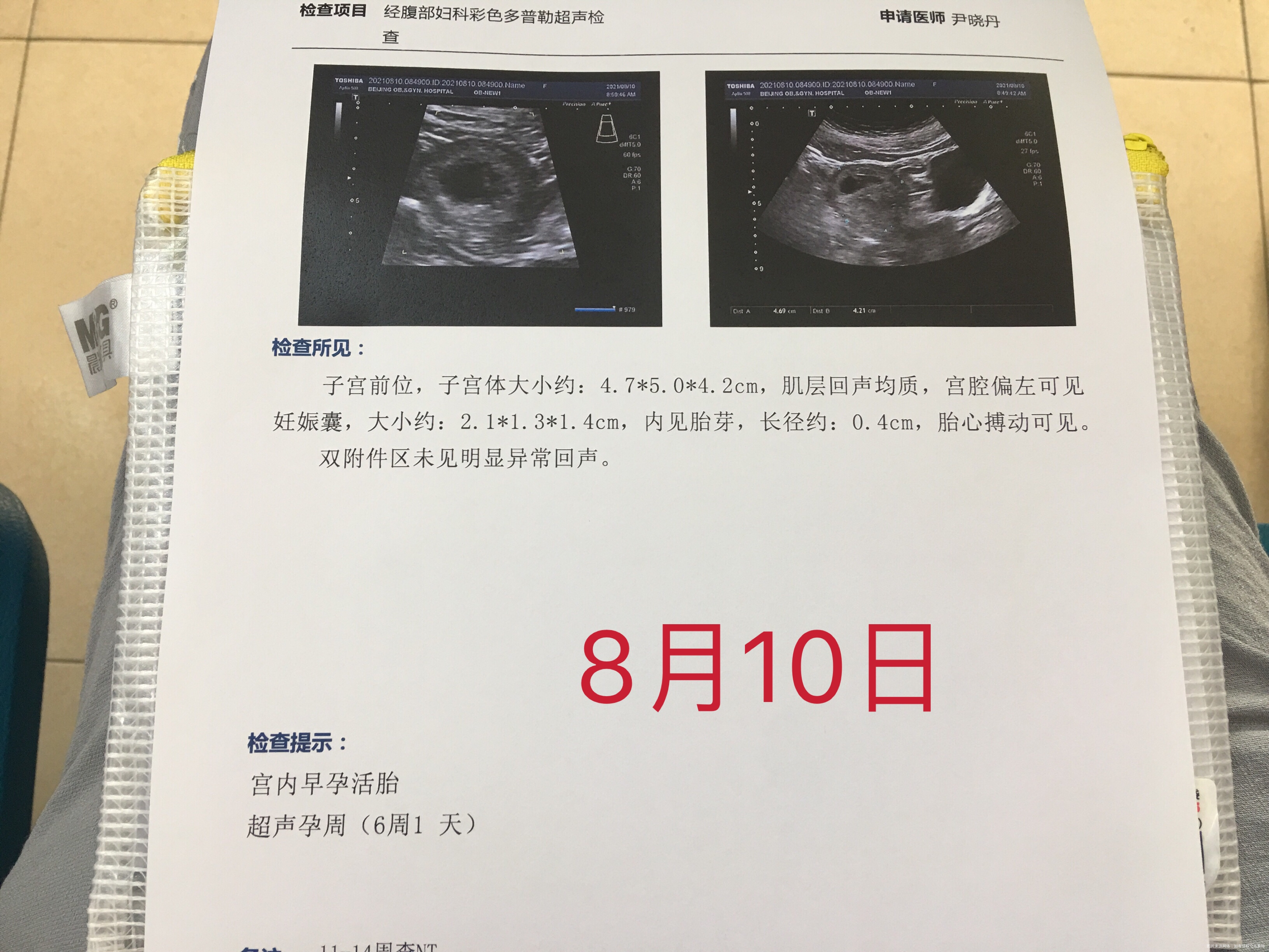 您好我现在孕7加4我的b超正常吗孕囊大小和胎