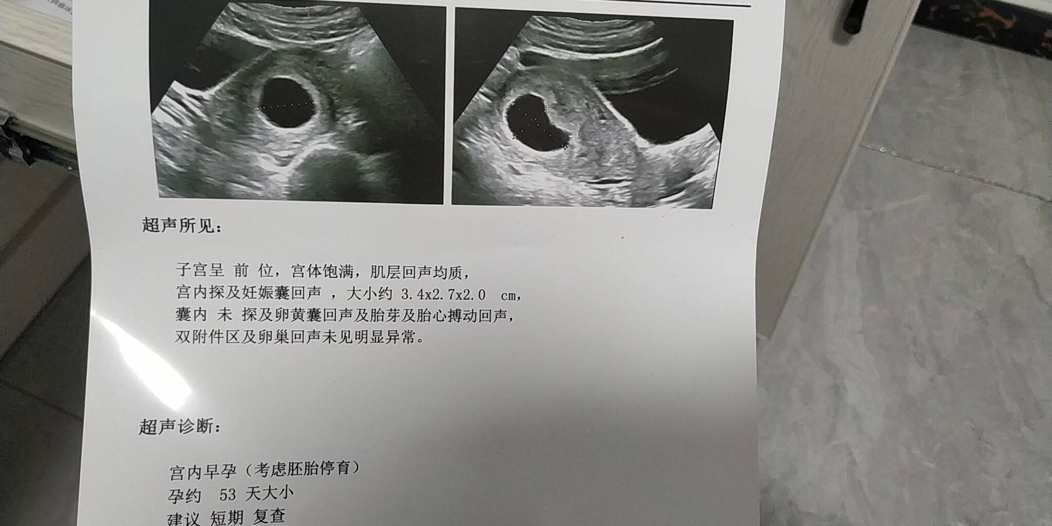 末次月经6月1号月经有时会推迟估计排卵晚B超