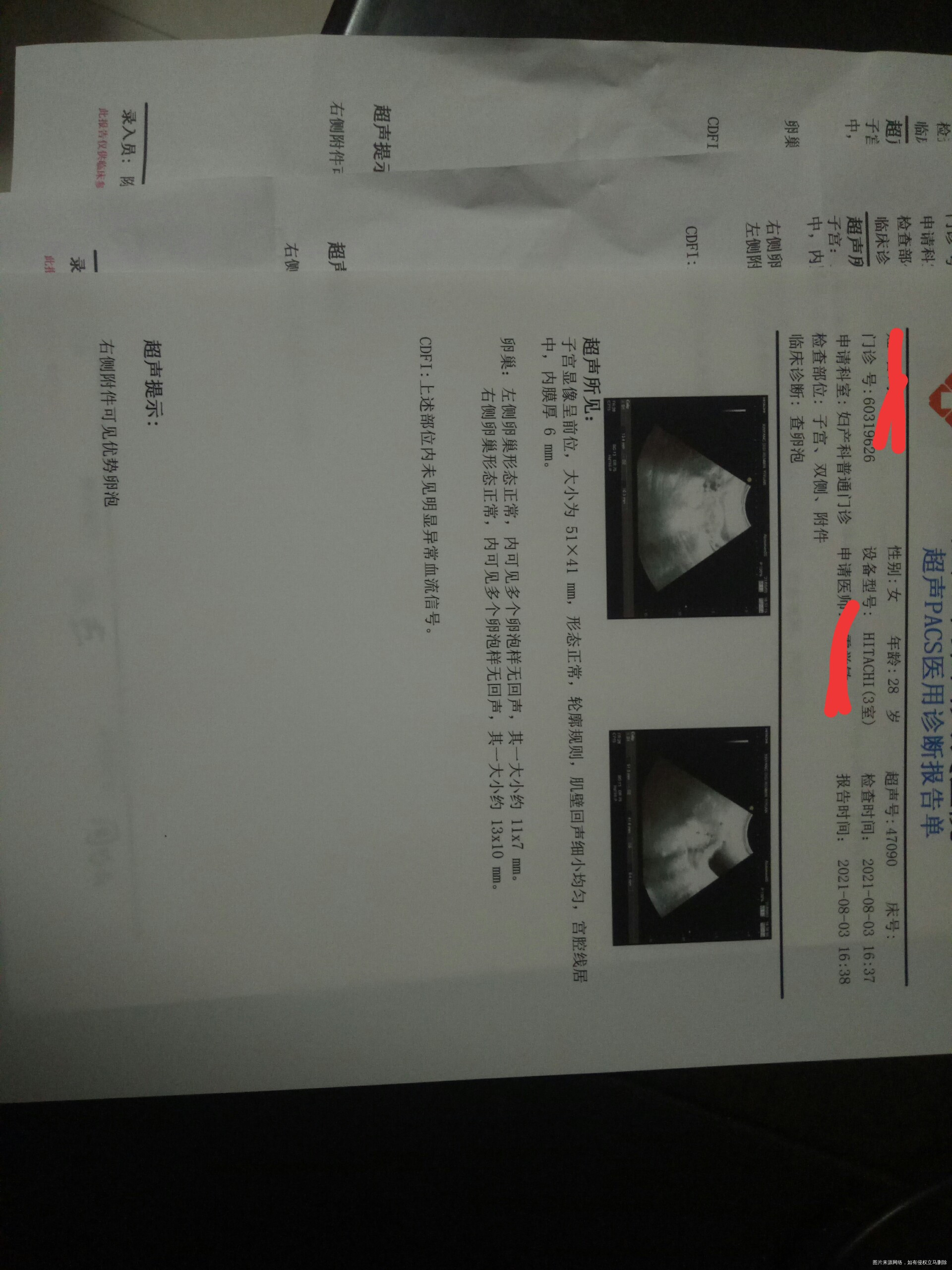 多囊性激素正常甲状腺也正常月经一般都很规律两