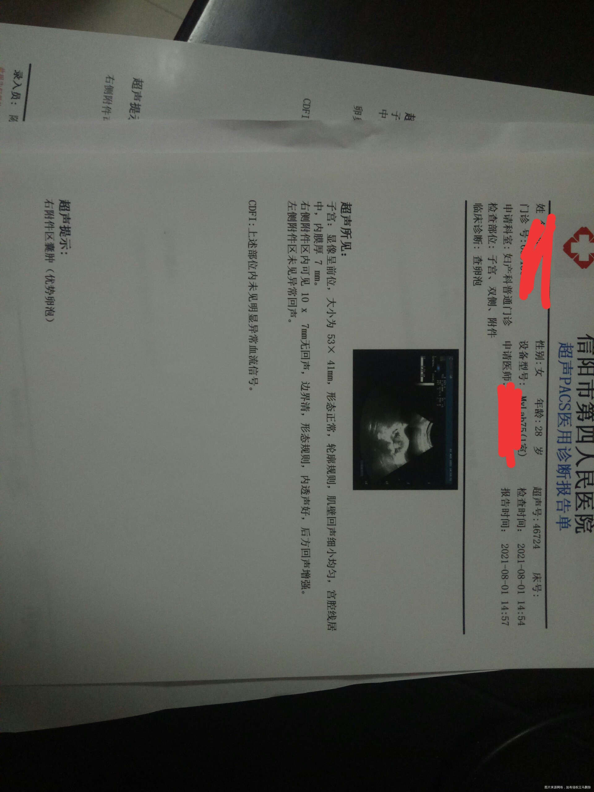 多囊性激素正常甲状腺也正常月经一般都很规律两