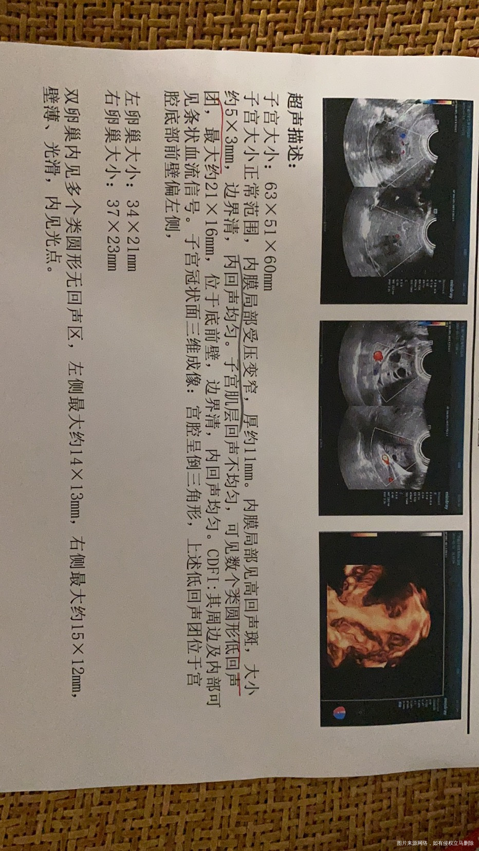 B超显示的是息肉还是肌瘤呢