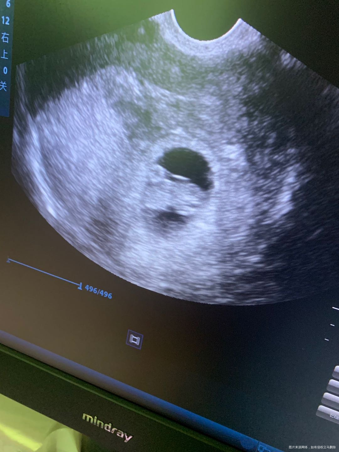 这张照片正常的吗图品中有没有宫腔积液或者盆腔