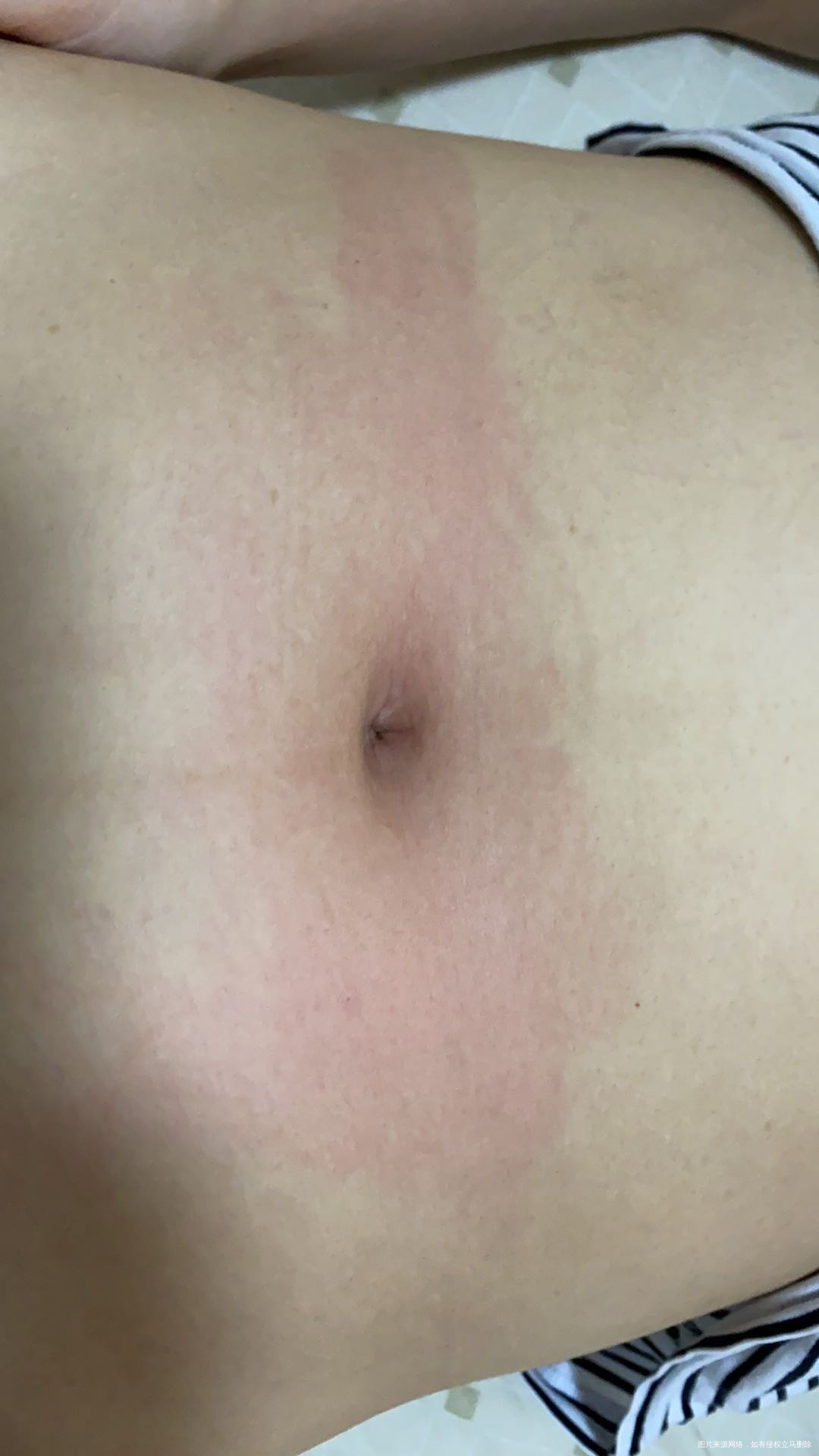 打了赛增局部皮肤发红怎么办