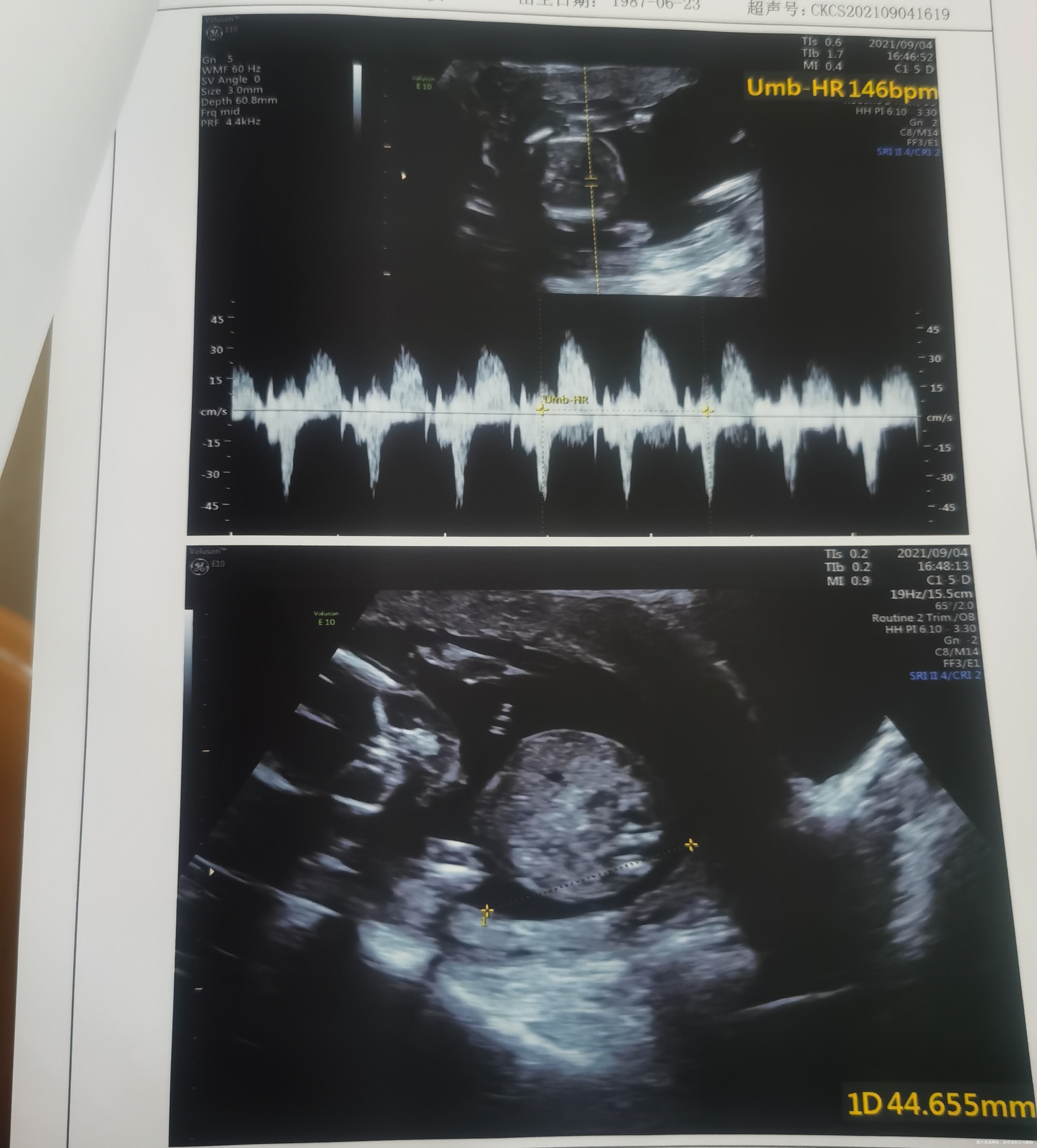 请医生帮我看一下1我有没有羊水过多2我的胎盘