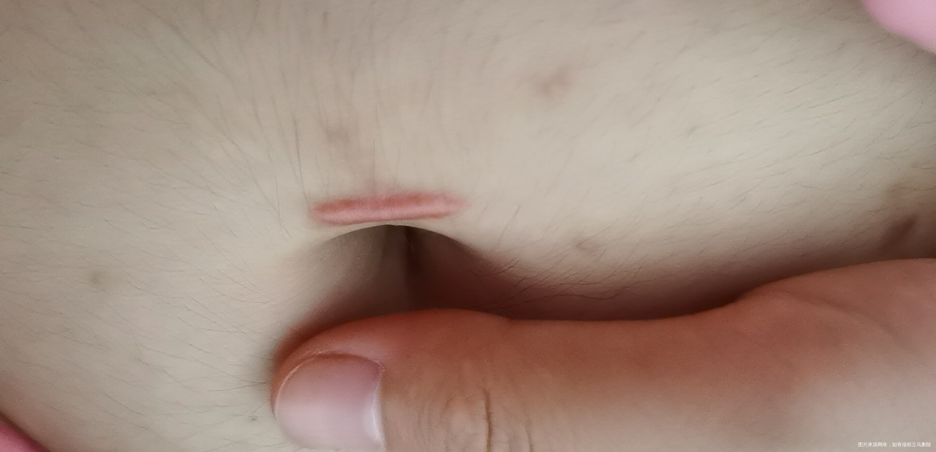 6月22做的腹腔镜手术因为黄体破裂和囊肿包块