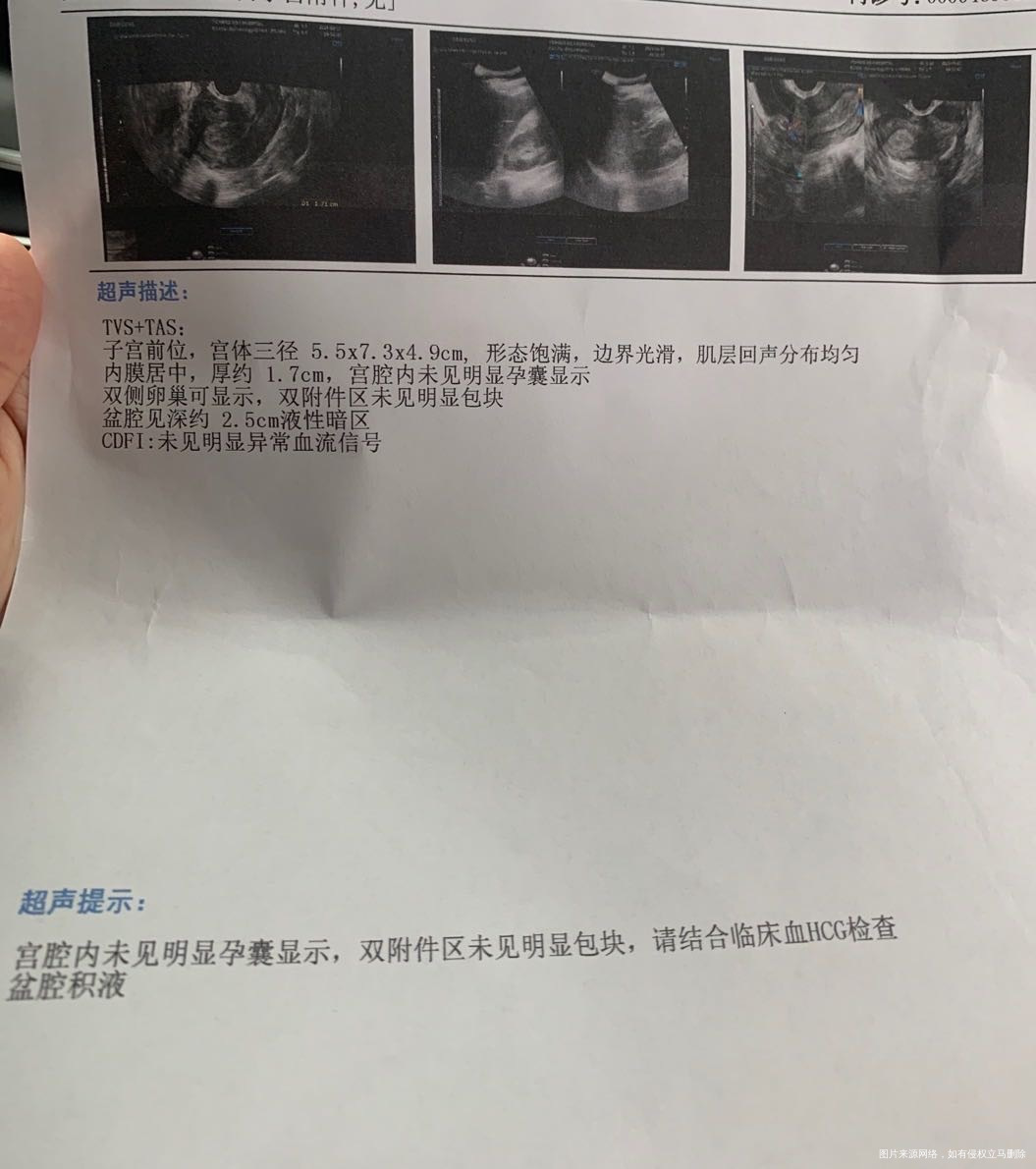 请问盆腔积液可能是已经流产了吗在保胎药作用下