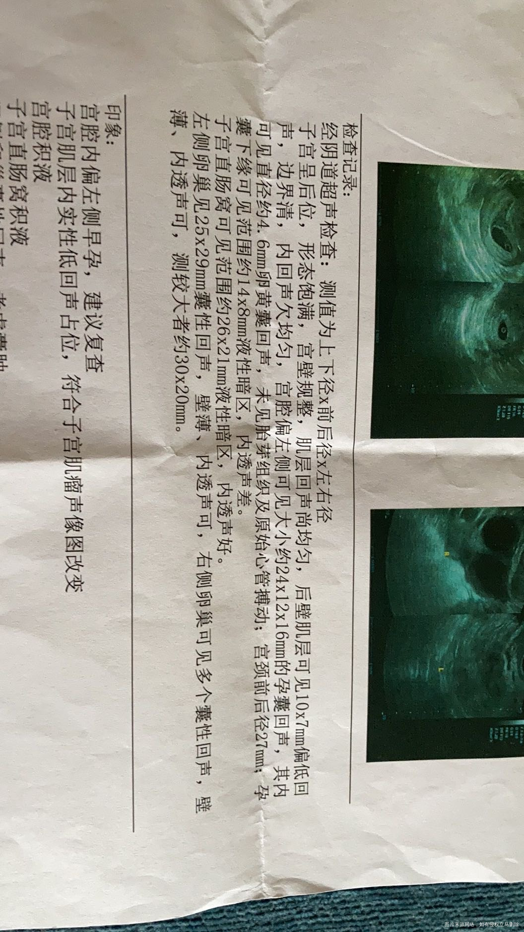 53天超声提示没有看到胎心问题大么同天HCG