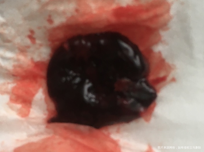 16号大出血后一直出黑褐色血27号出了血块开