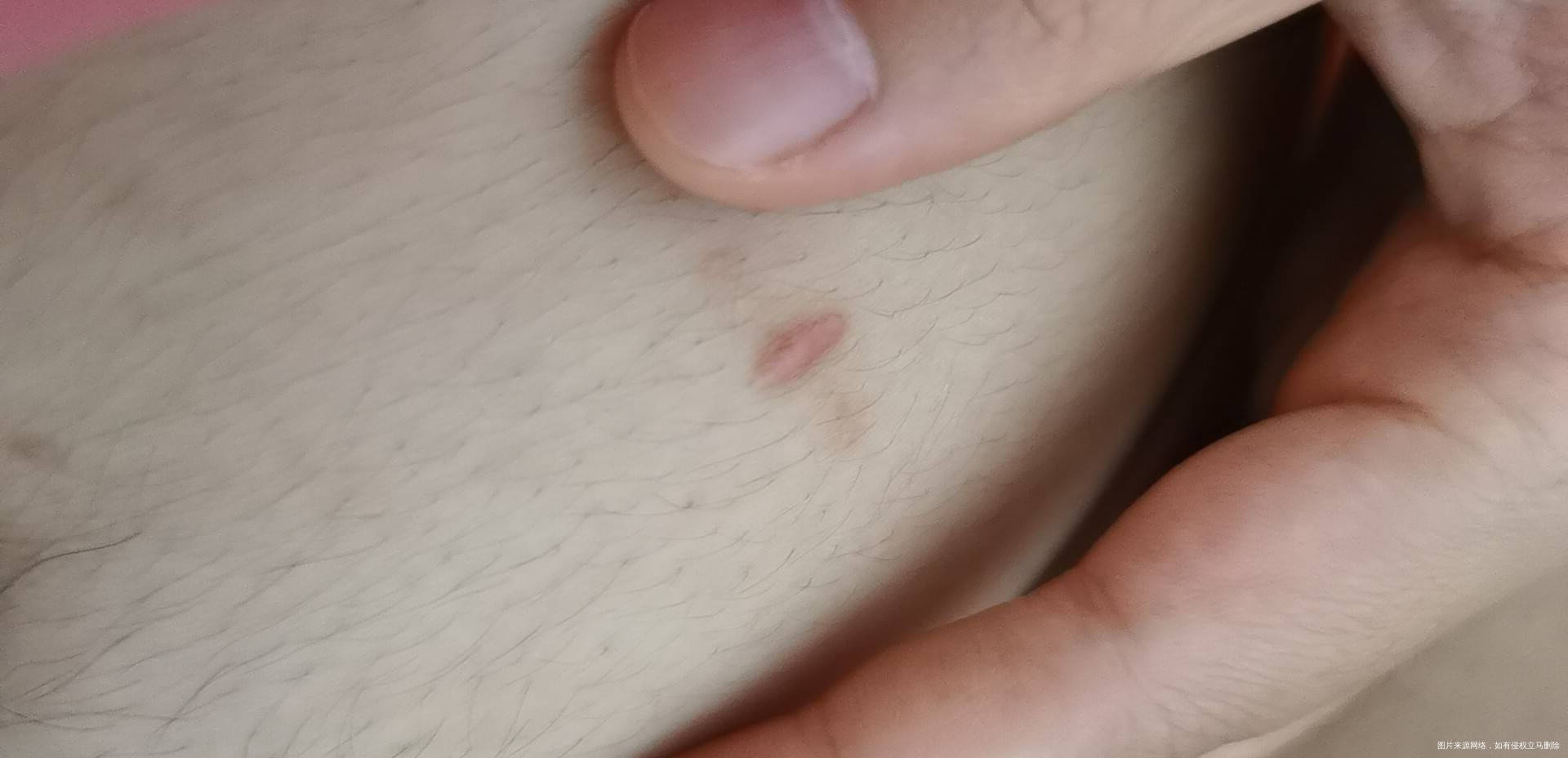 6月22做的腹腔镜手术因为黄体破裂和囊肿包块