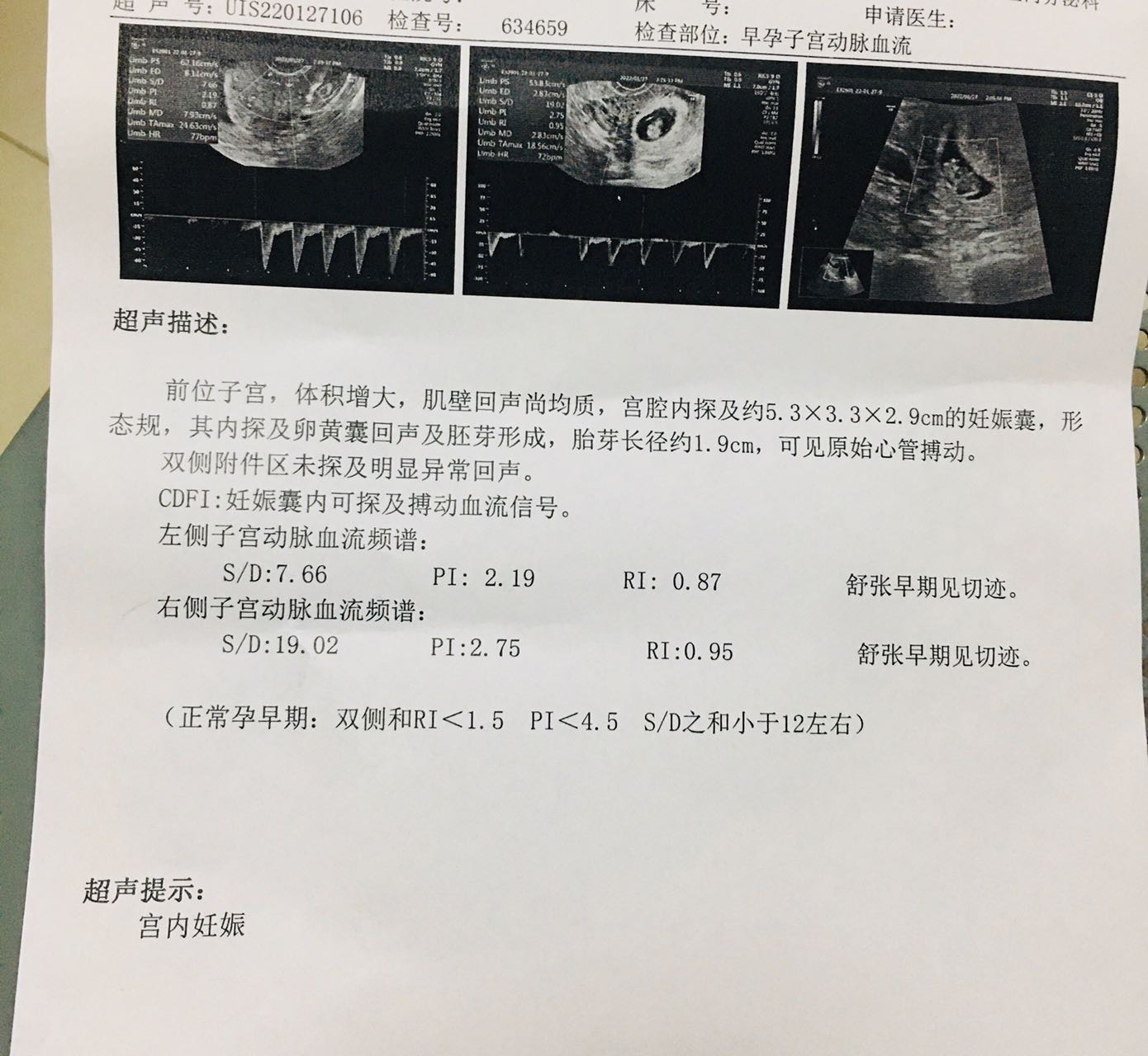 试管婴儿今天孕58天子宫动脉太高上周查的还可