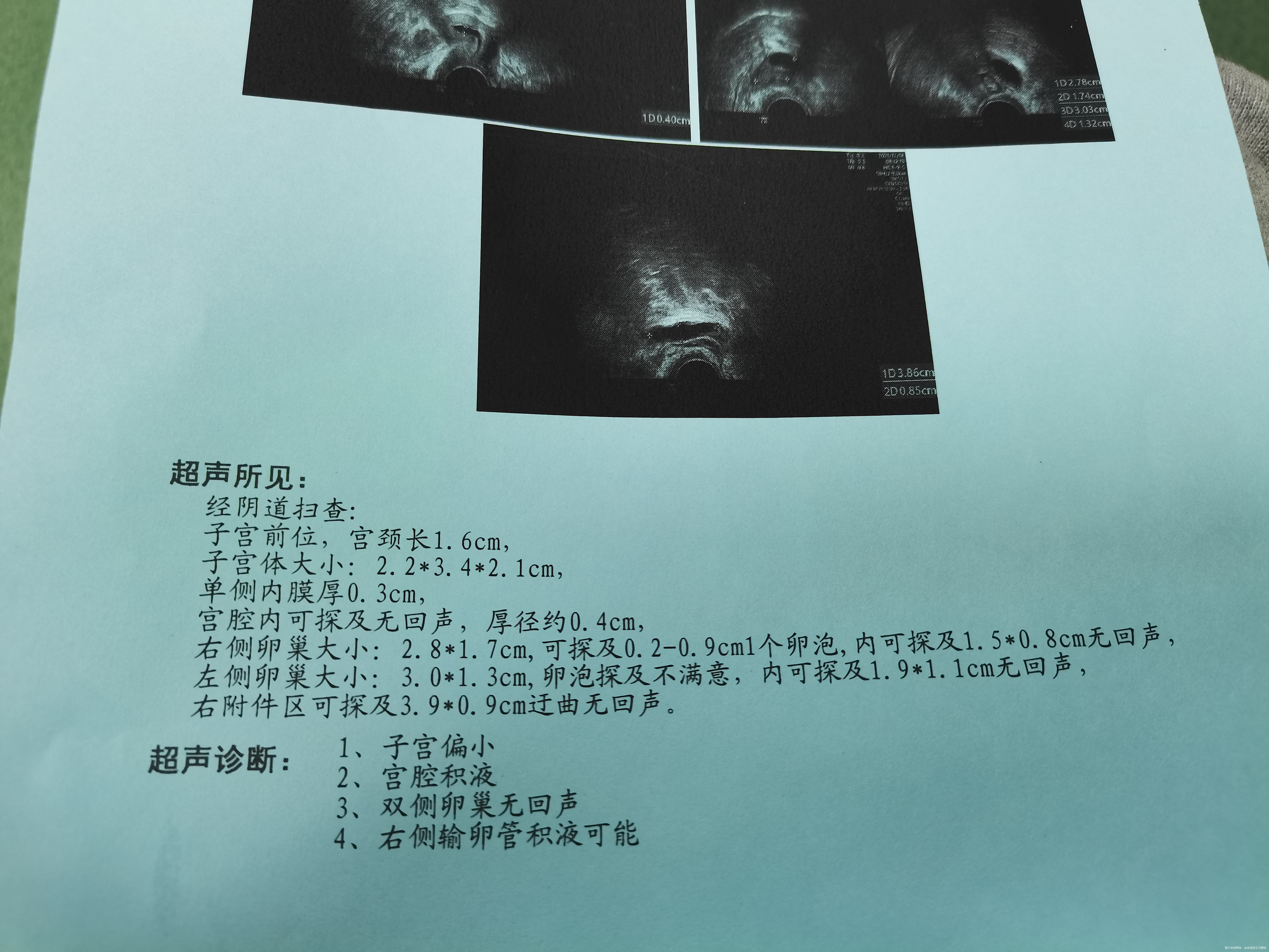 子宫偏小可以做试管婴儿怀孕吗