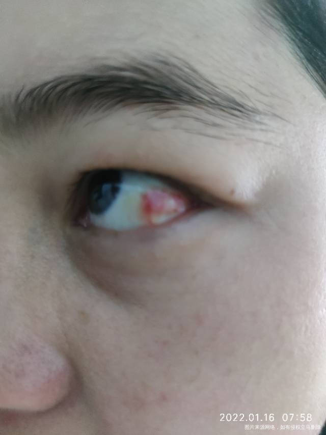 我这眼睛前两天有点痛觉不是很痛总感觉有什么异